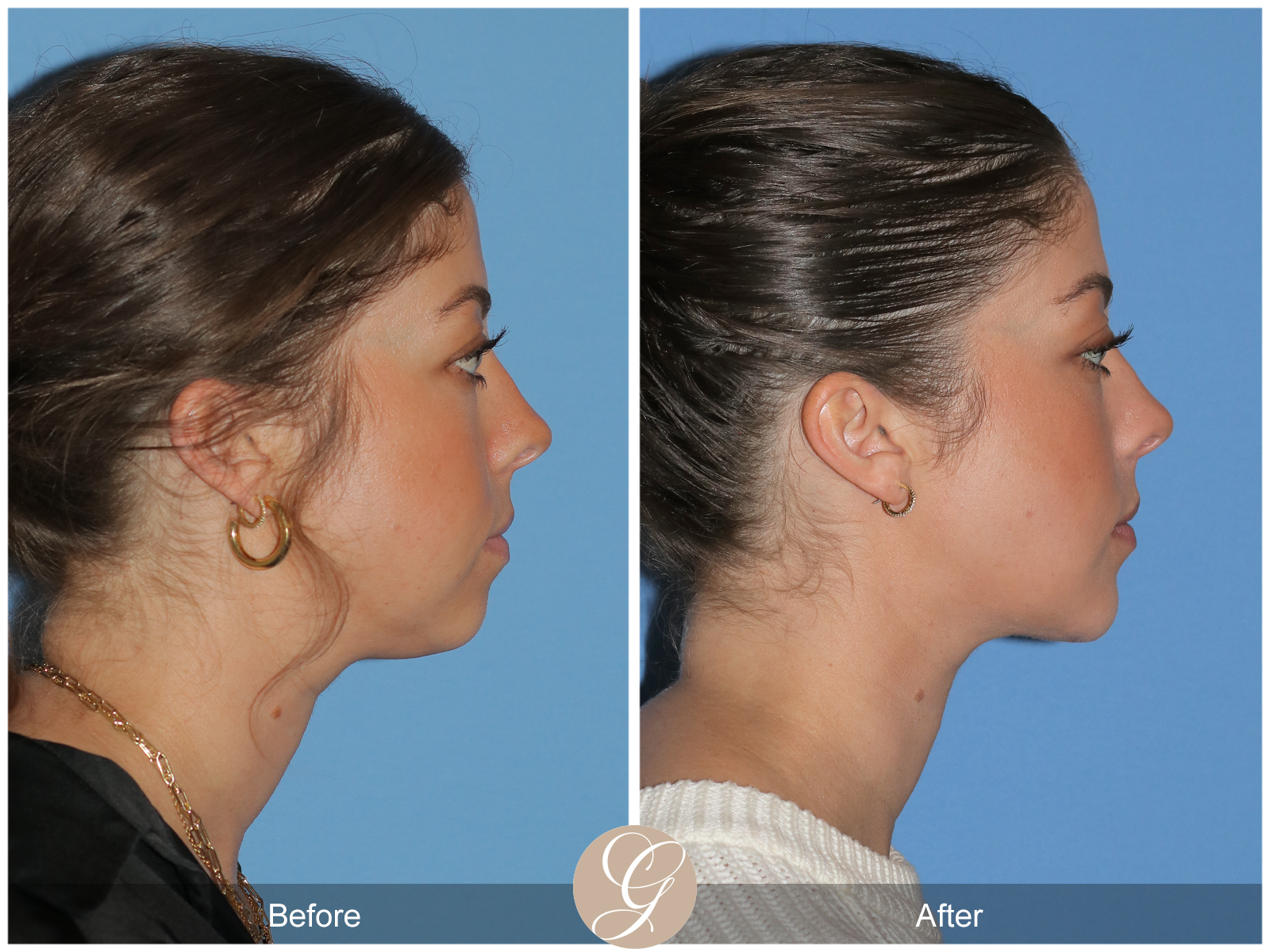 Facial Contouring Case 3 Image