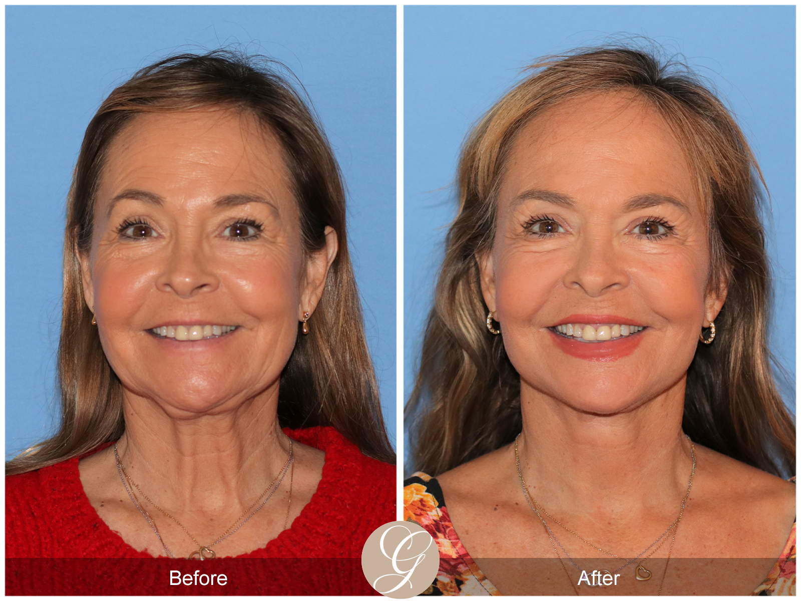 Preservation Deep Plane Facelift Case 45 Image