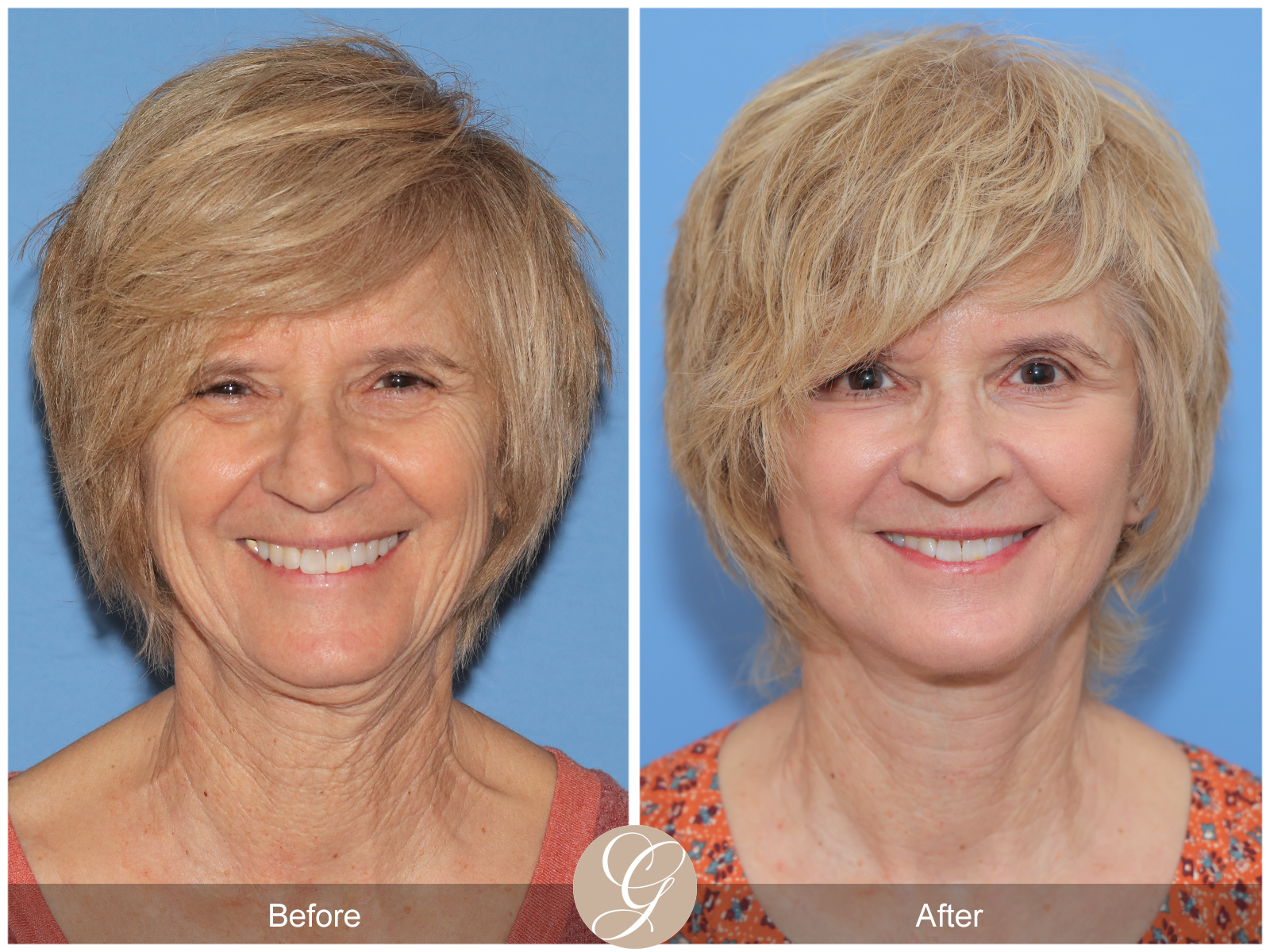 Preservation Deep Plane Facelift Case 39 Image