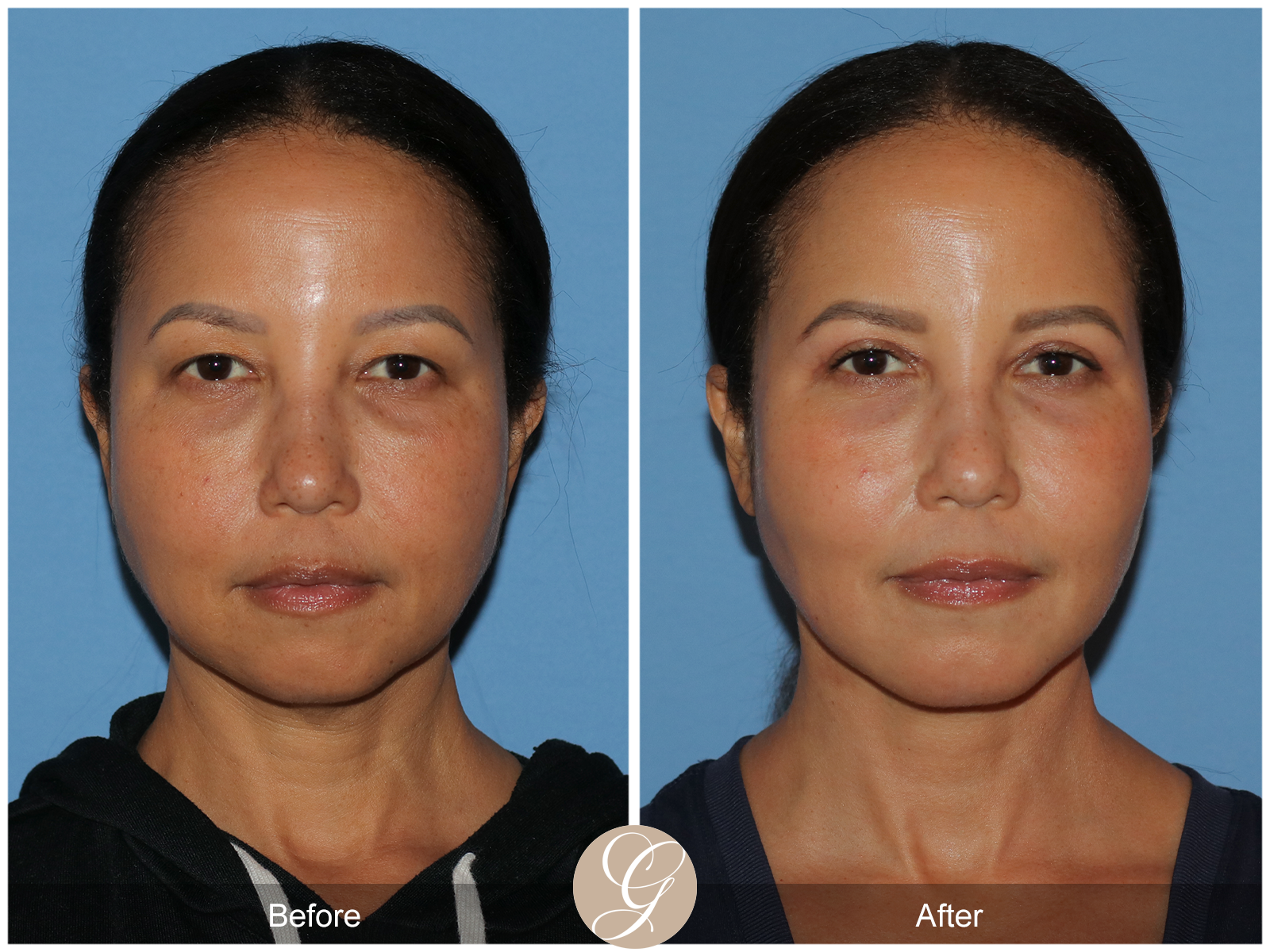 Facial Contouring Case 5 Image