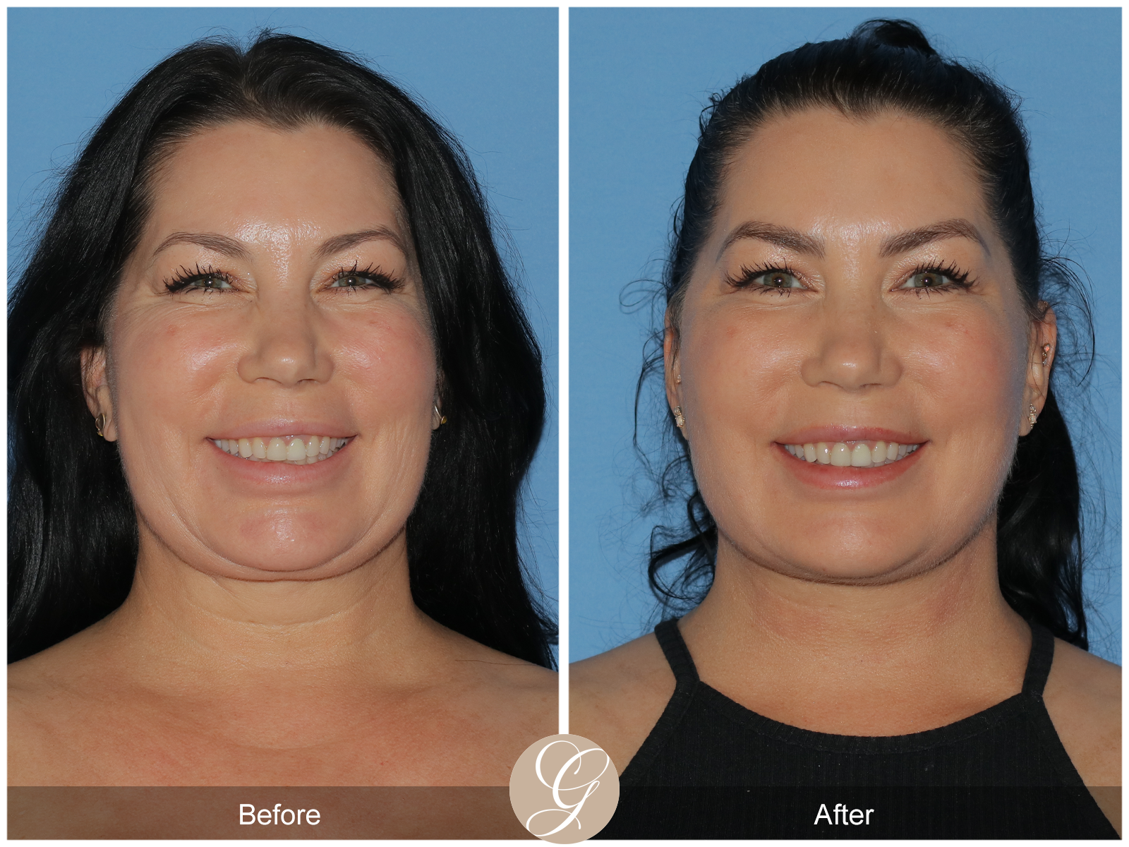 Deep Plane Facelift Case 34 Image