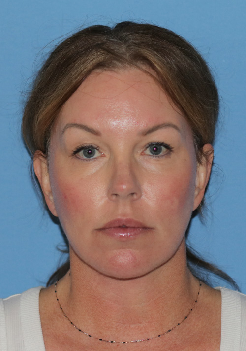 Deep Plane Facelift Case 33 After Image