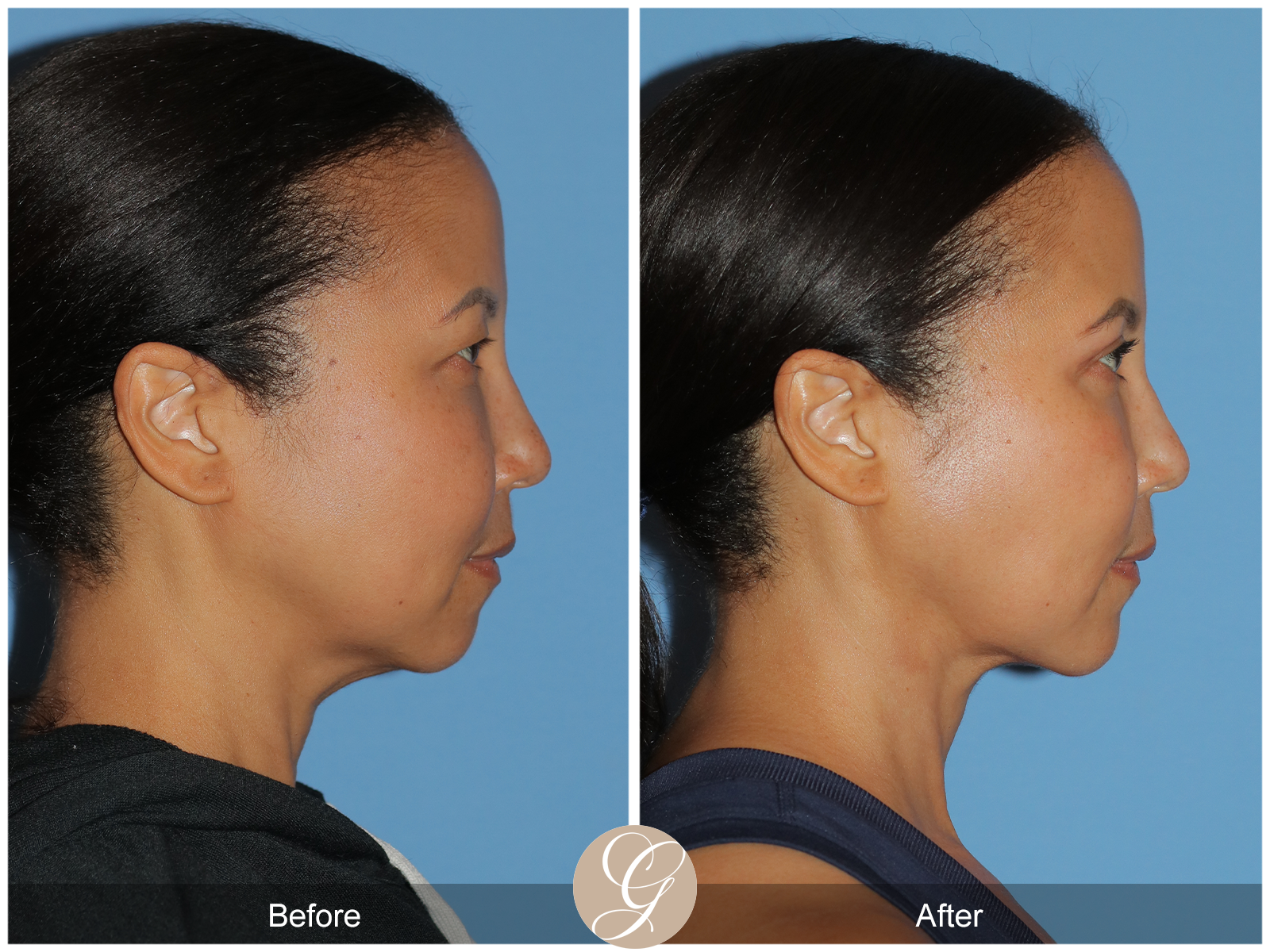 Facial Contouring Case 5 Image