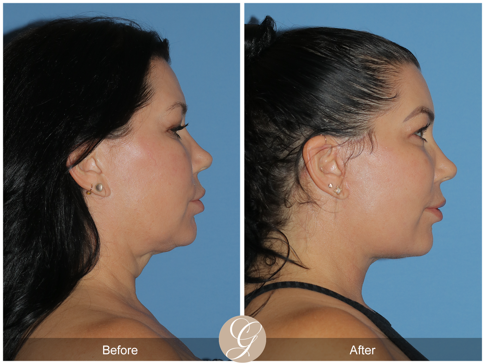 Deep Plane Facelift Case 34 Image