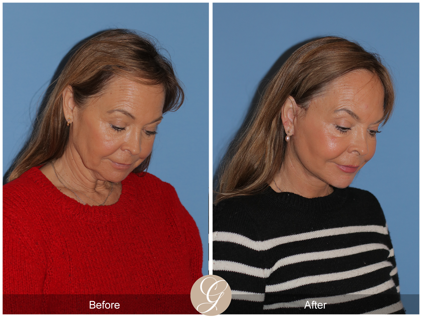 Preservation Deep Plane Facelift Case 45 Image