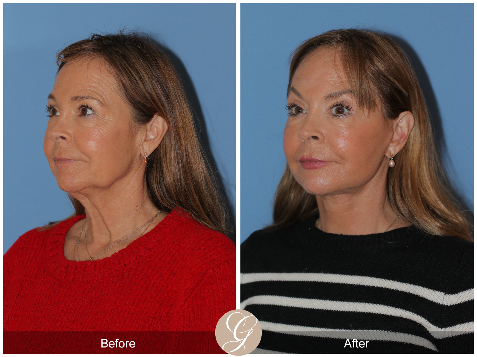 Preservation Deep Plane Facelift Case 45 Image