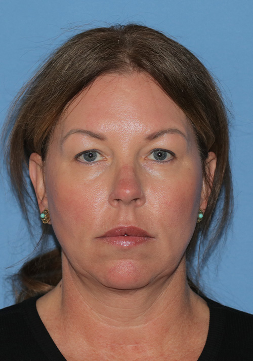 Deep Plane Facelift Case 33 Before Image