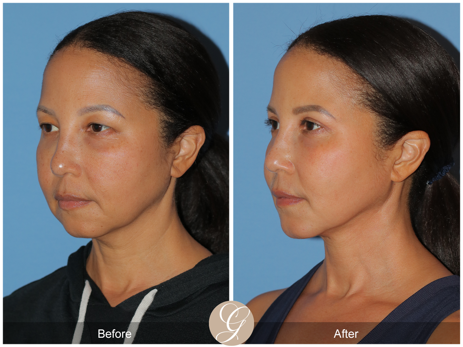 Facial Contouring Case 5 Image