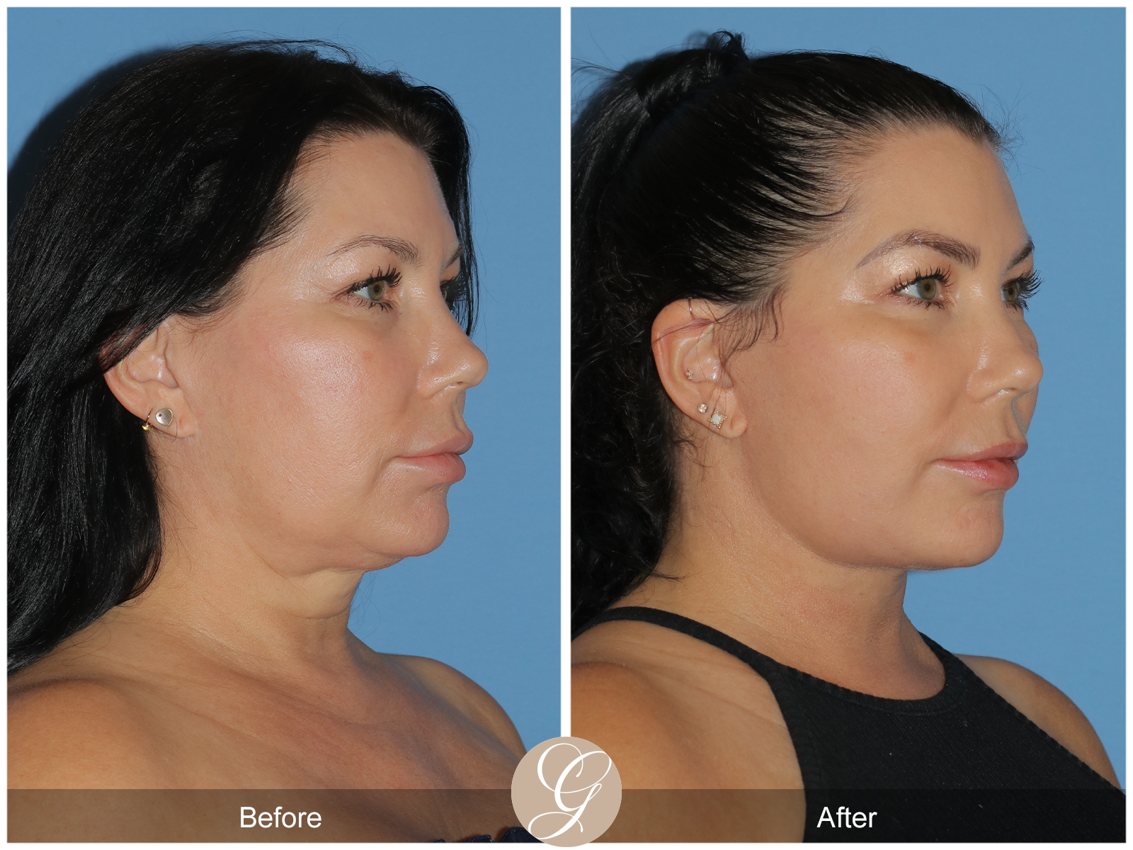 Deep Plane Facelift Case 34 Image
