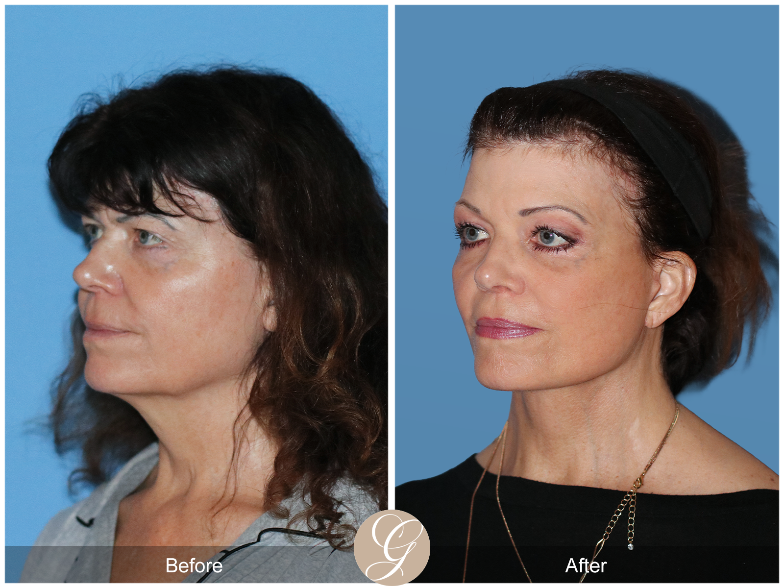 Preservation Deep Plane Facelift Case 51 Image