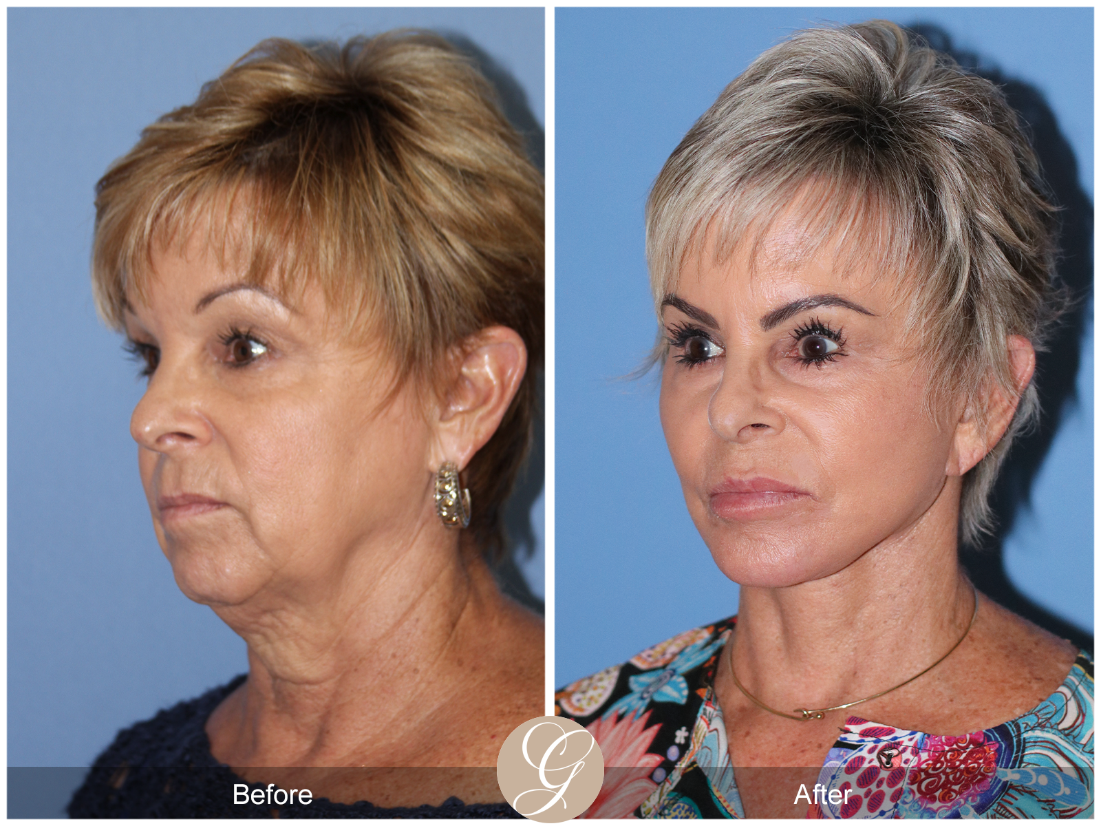 Preservation Deep Plane Facelift Case 52 Image