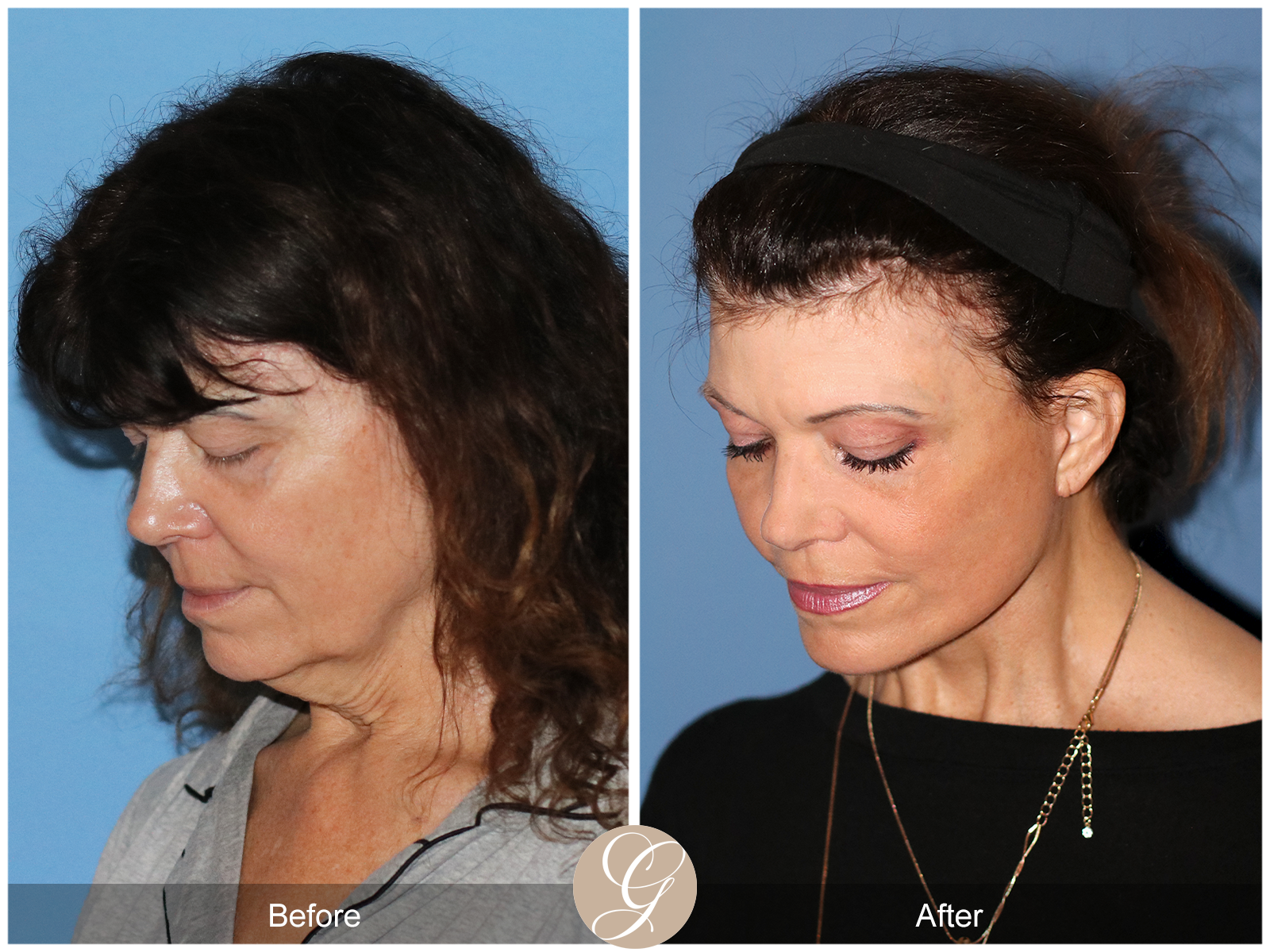 Preservation Deep Plane Facelift Case 51 Image