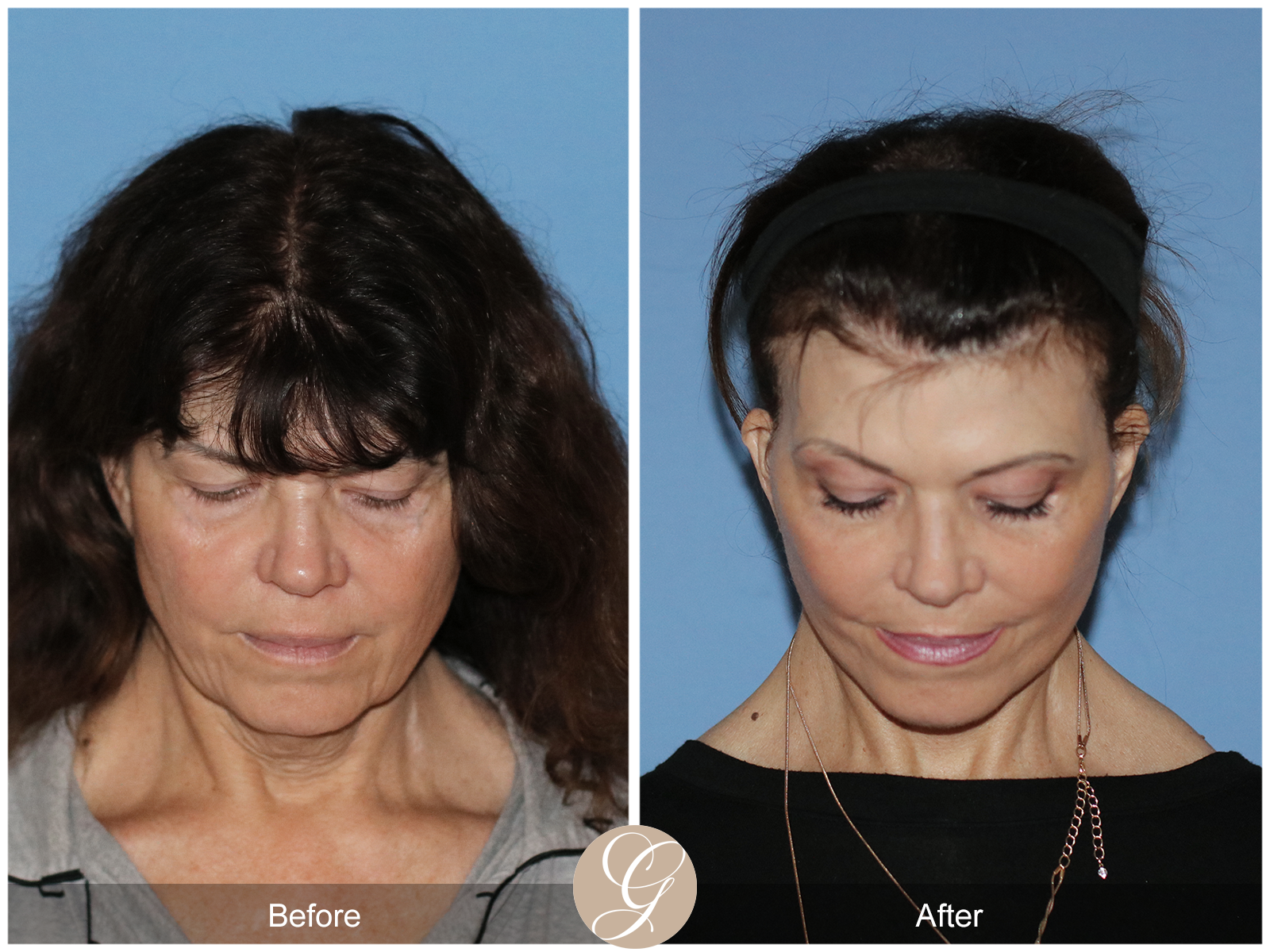 Preservation Deep Plane Facelift Case 51 Image