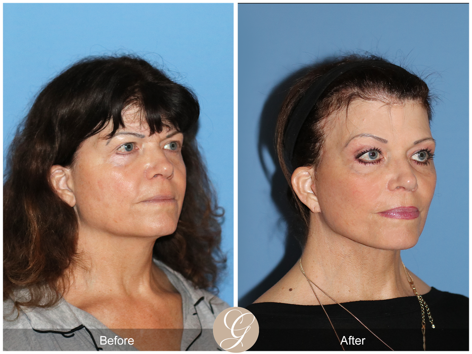 Preservation Deep Plane Facelift Case 51 Image