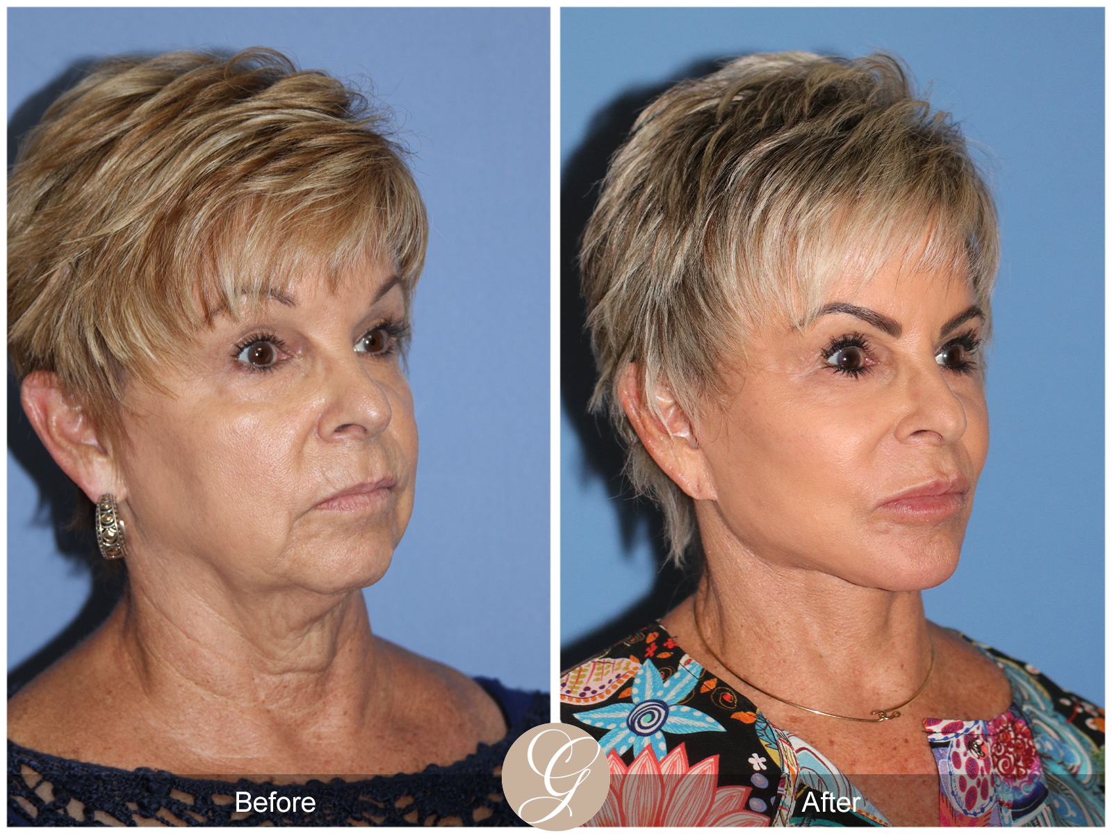 Preservation Deep Plane Facelift Case 52 Image