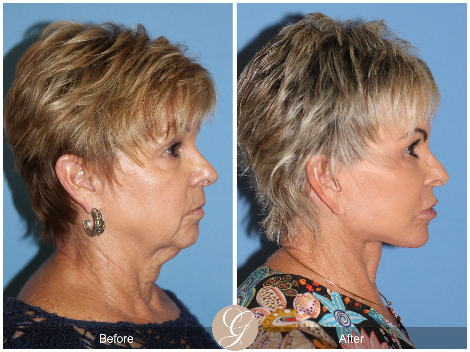 Preservation Deep Plane Facelift Case 52 Image