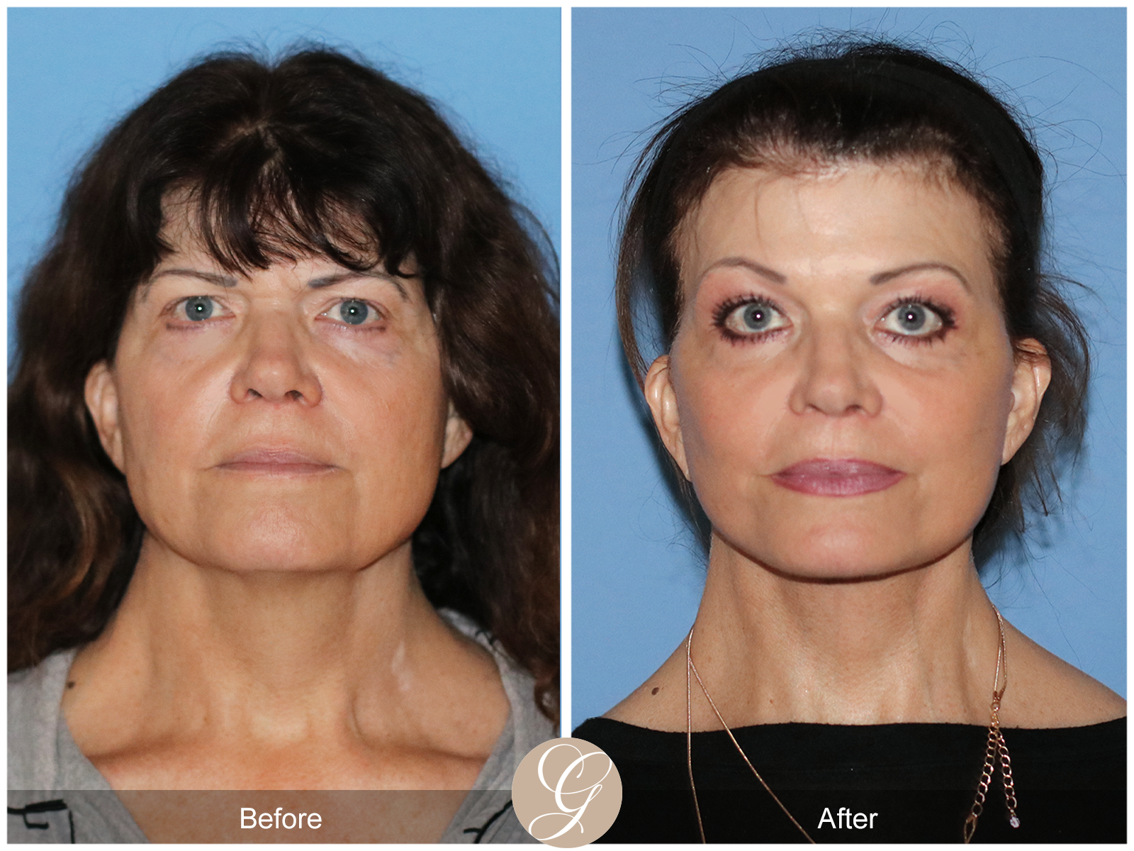 Preservation Deep Plane Facelift Case 51 Image