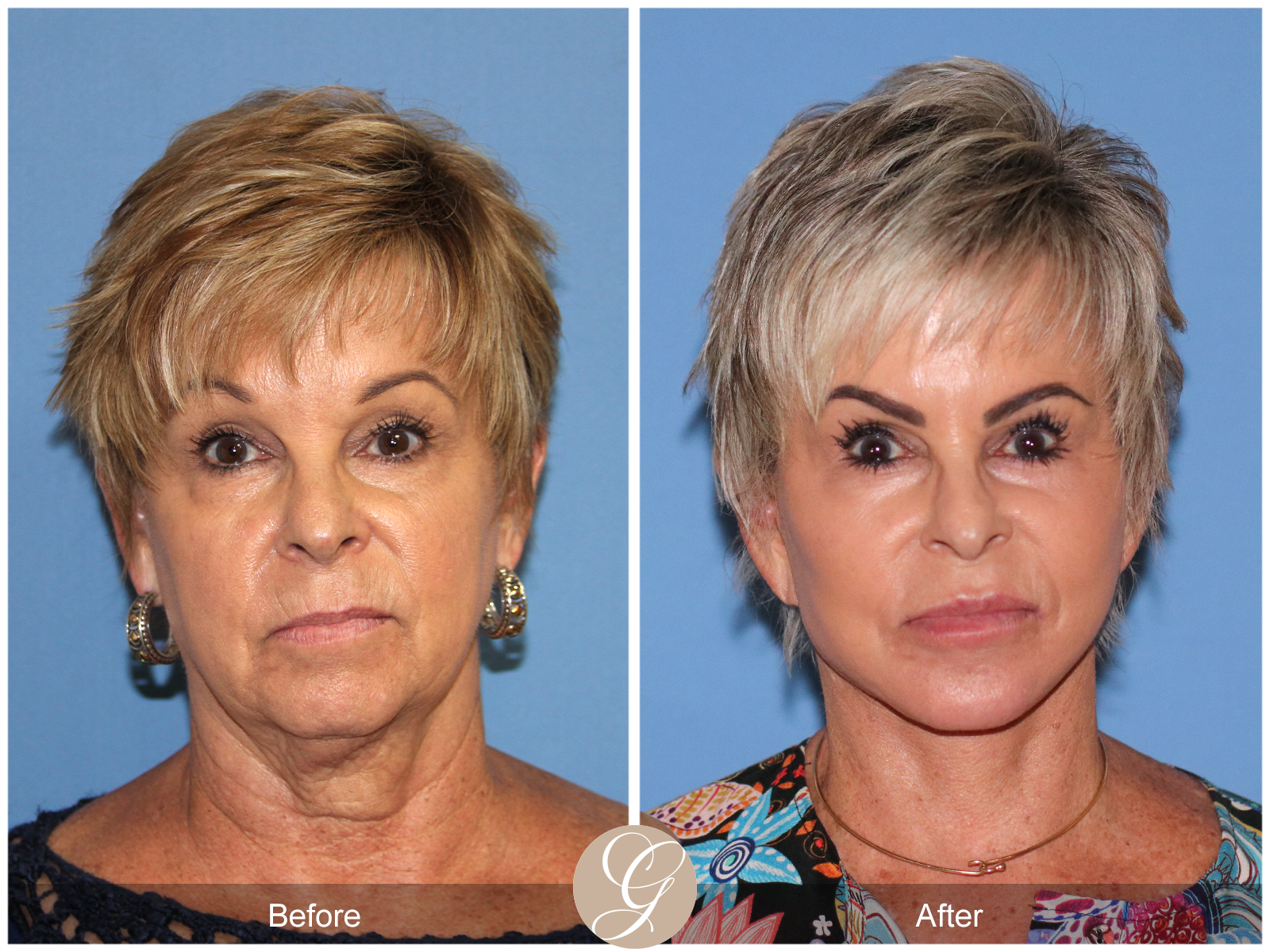 Preservation Deep Plane Facelift Case 52 Image