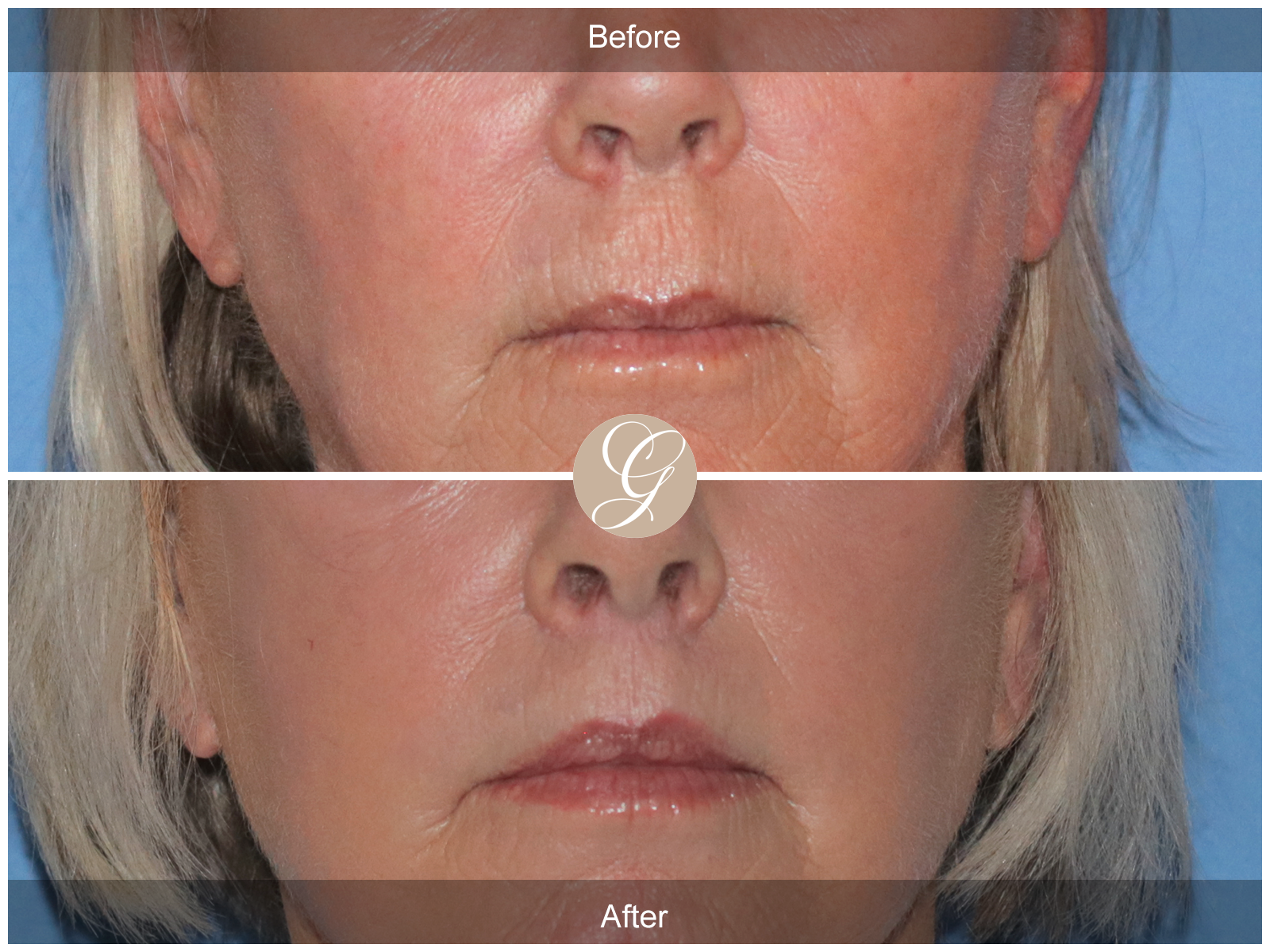 Lip Lift 7112 Image
