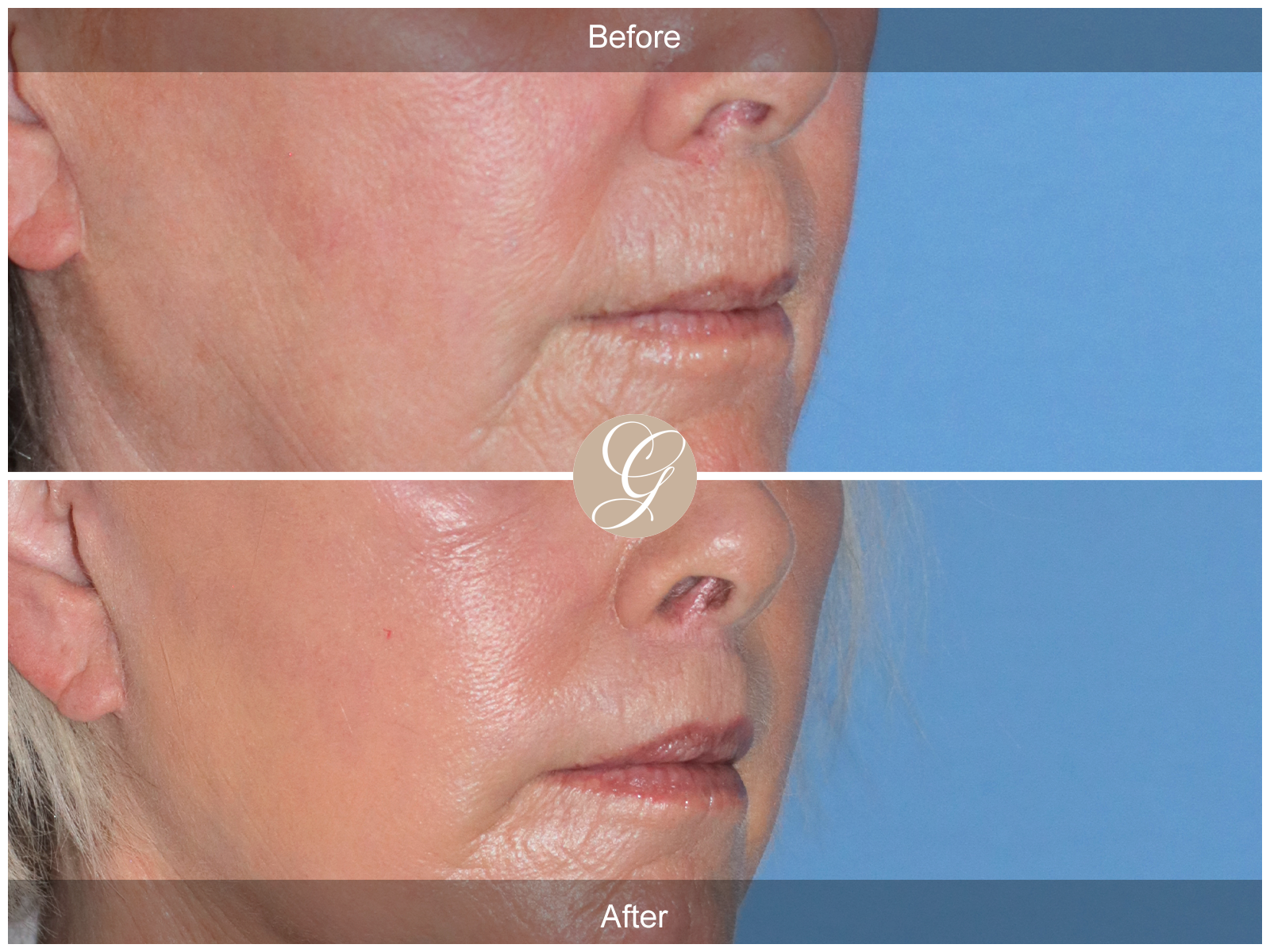 Lip Lift 7112 Image
