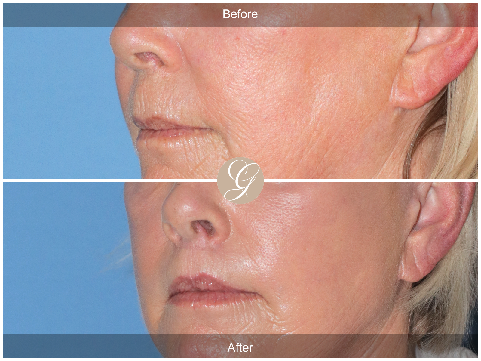 Lip Lift 7112 Image