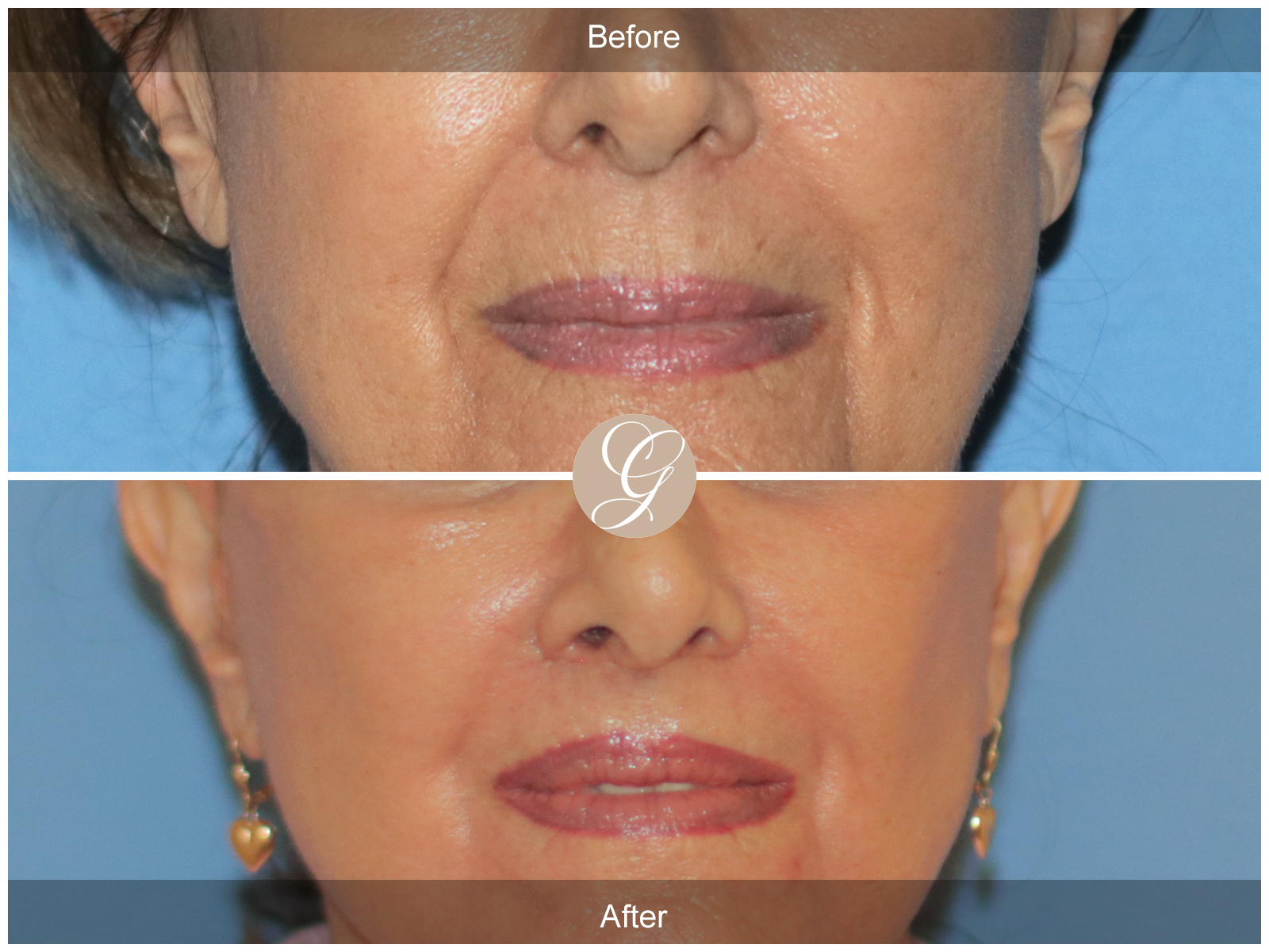Lip Lift 5577 Image