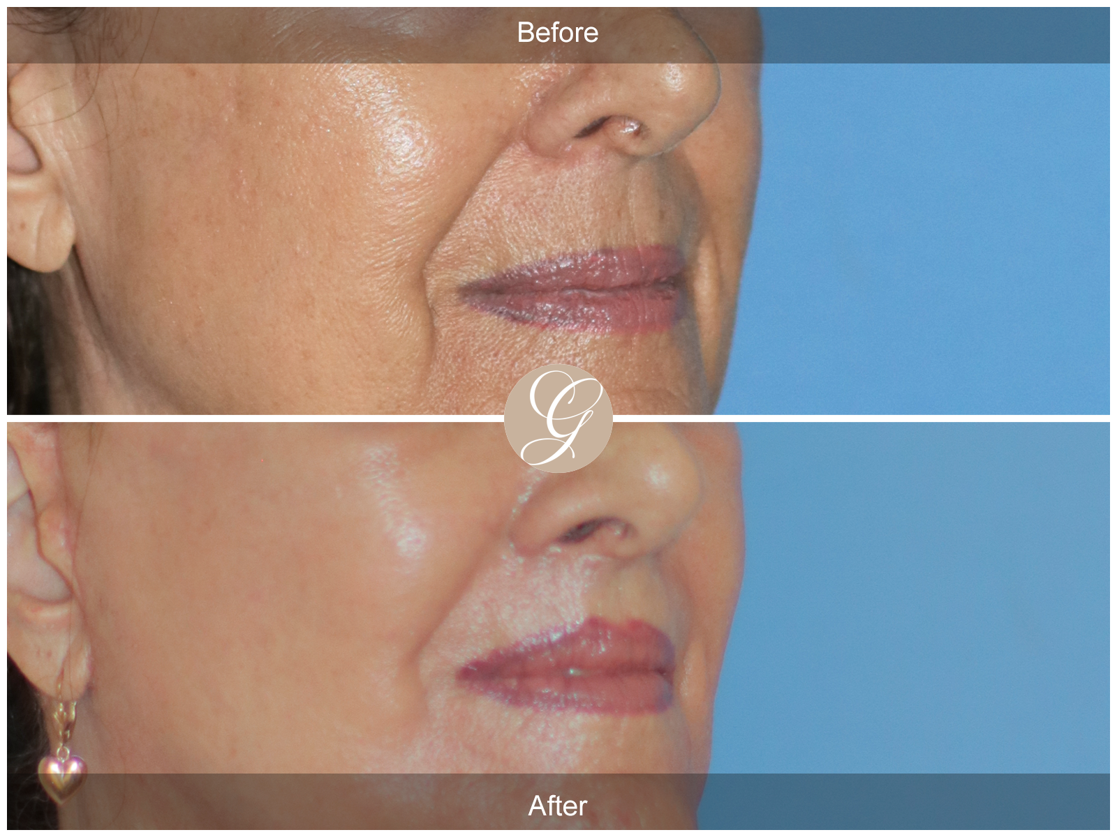 Lip Lift 5577 Image