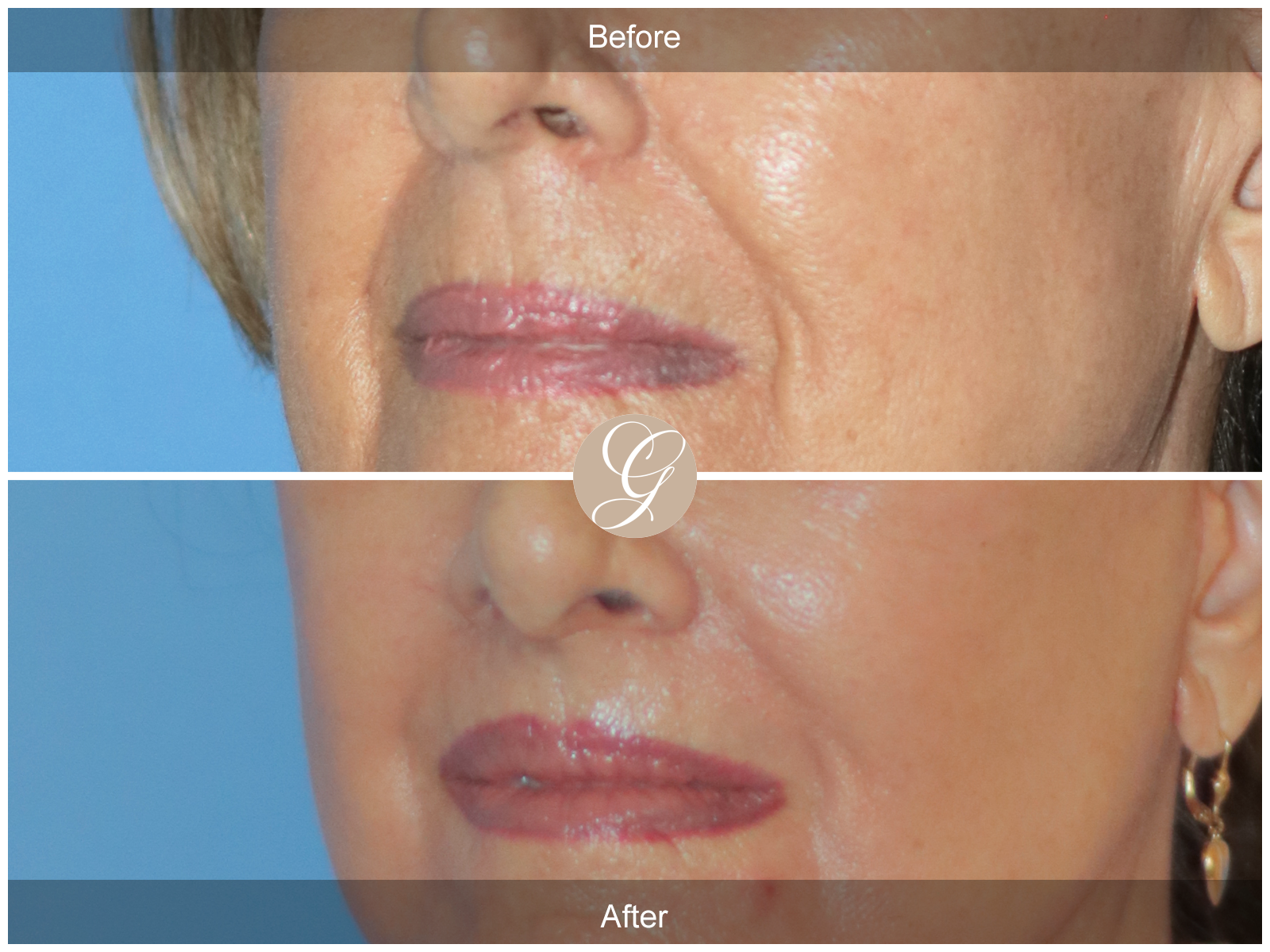 Lip Lift 5577 Image