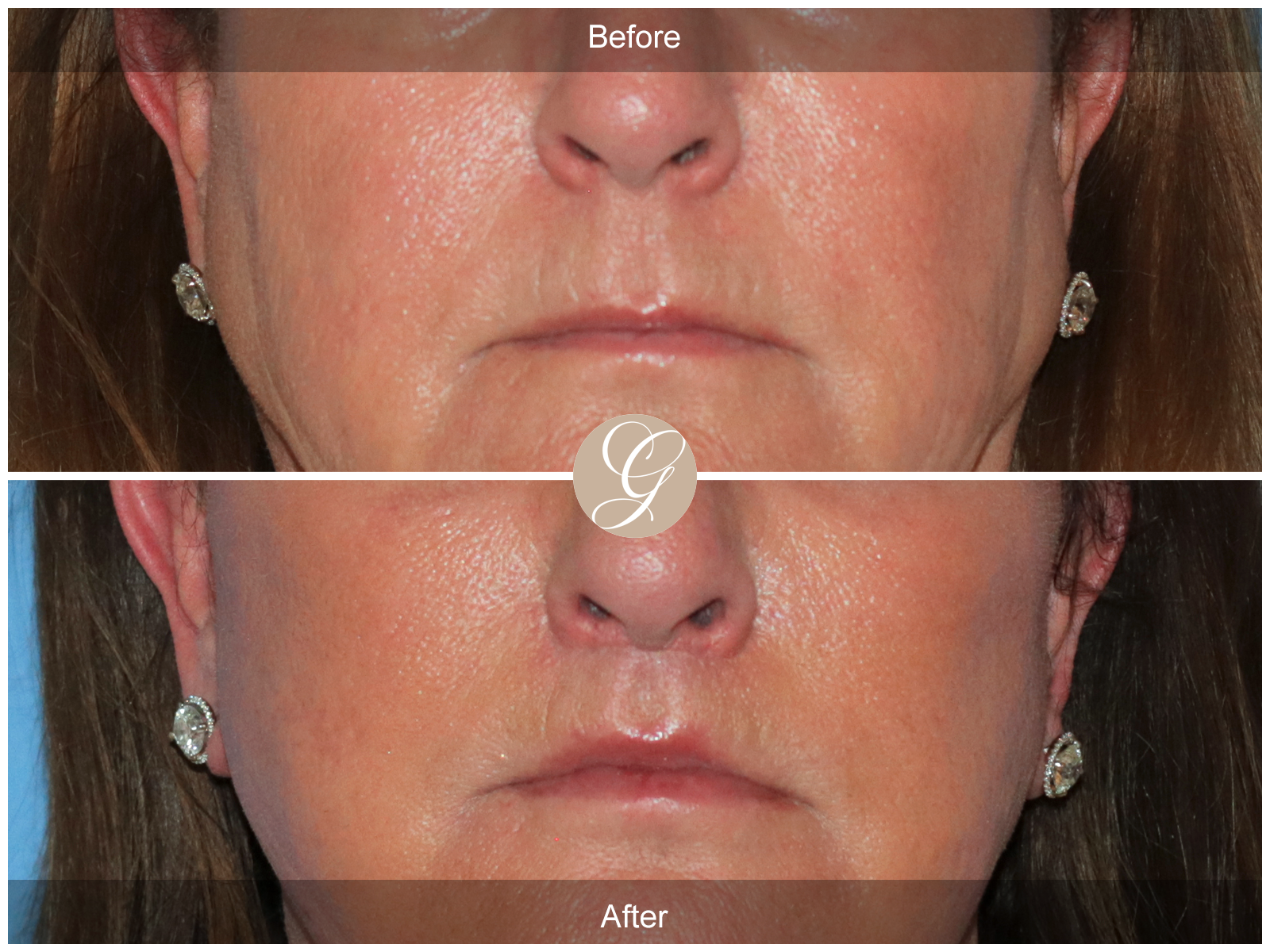 Lip Lift 8944 Image