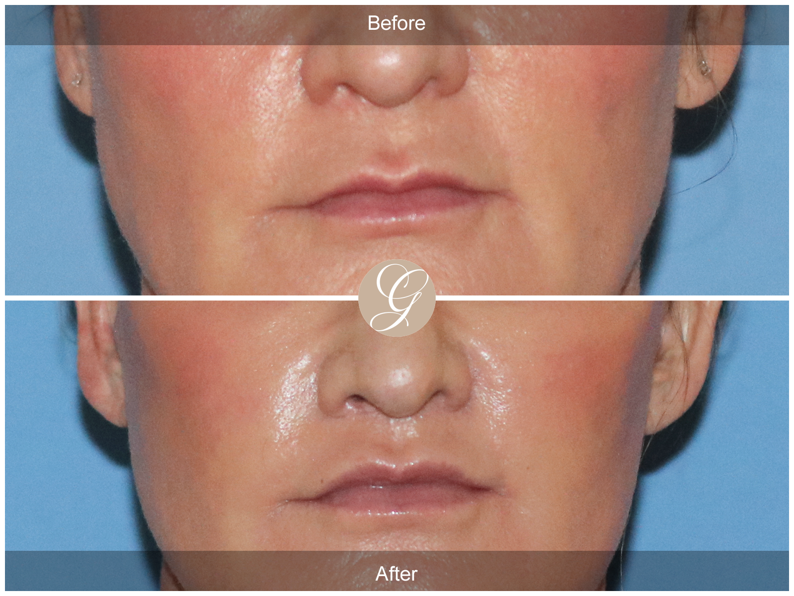 Lip Lift 0927 Image