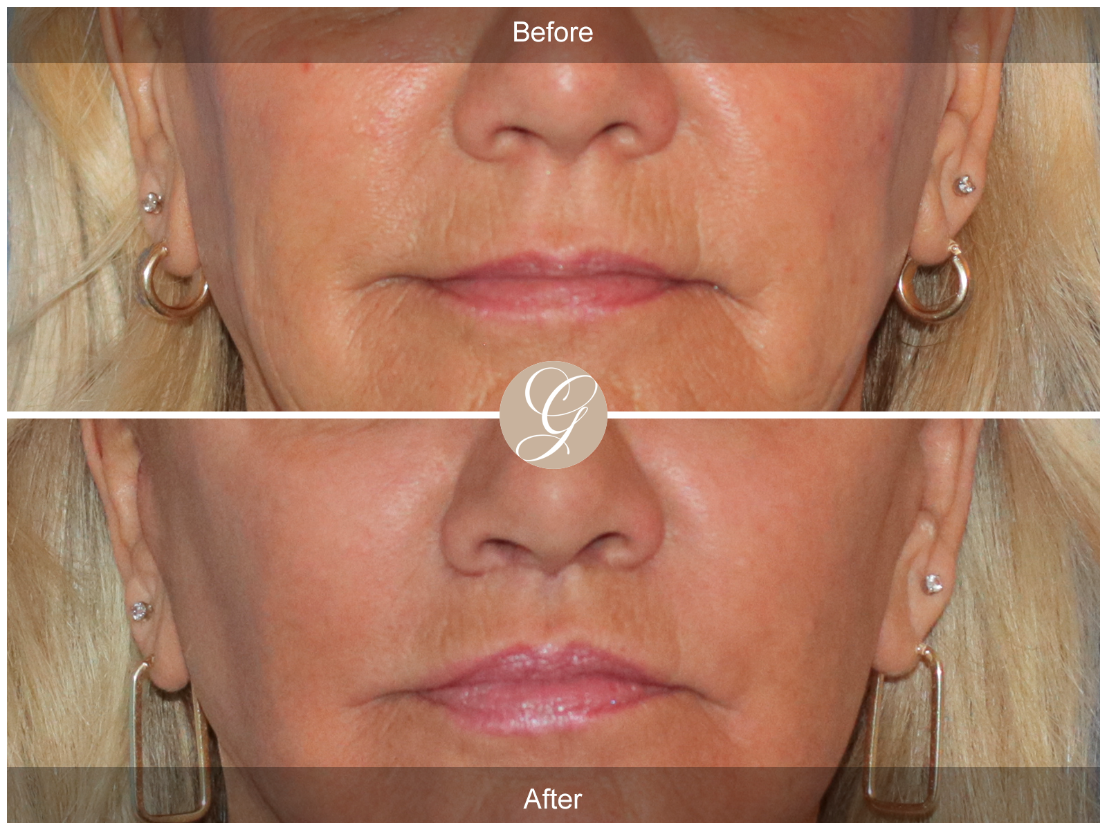 Lip Lift 2096 Image