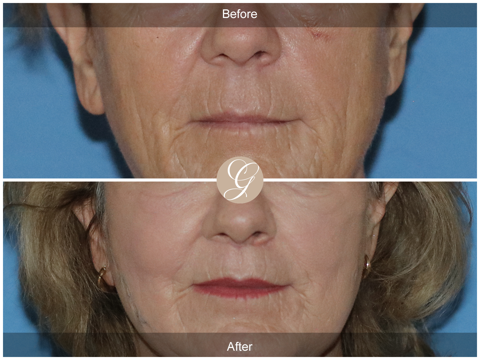 Lip Lift 0764 Image