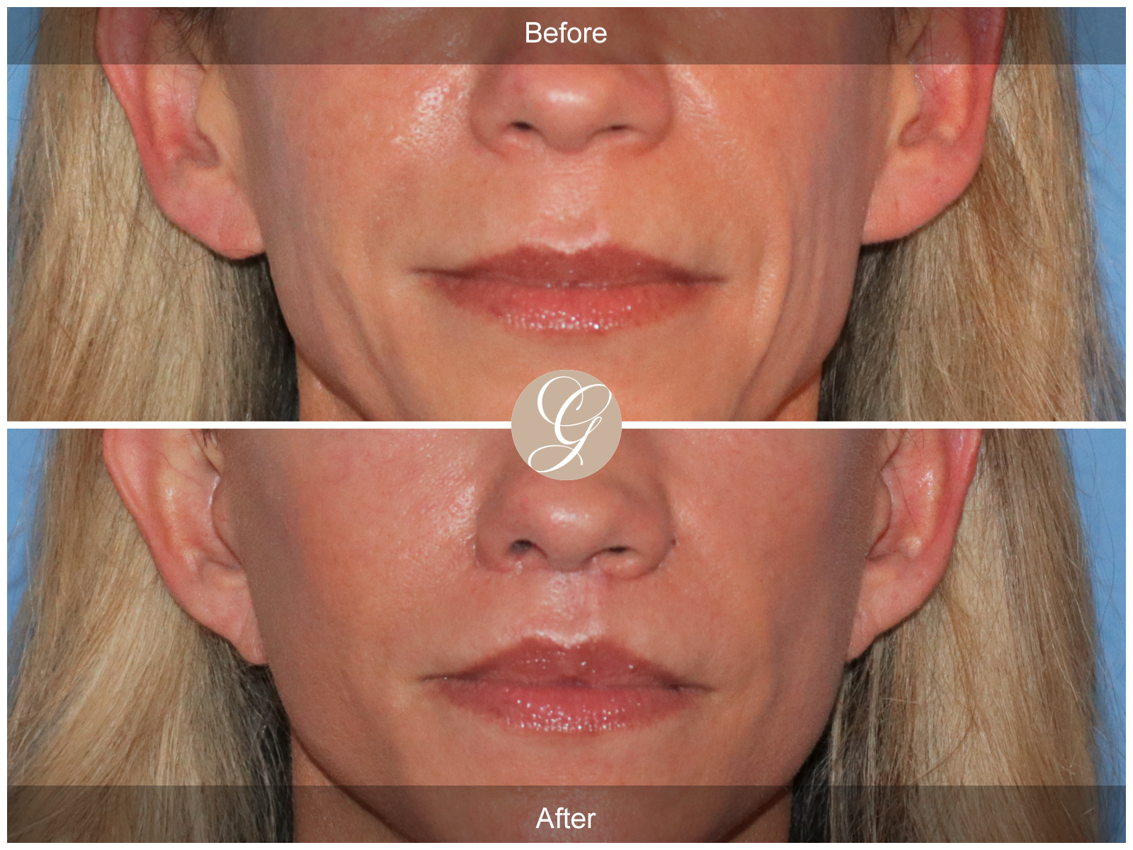 Lip Lift 9245 Image