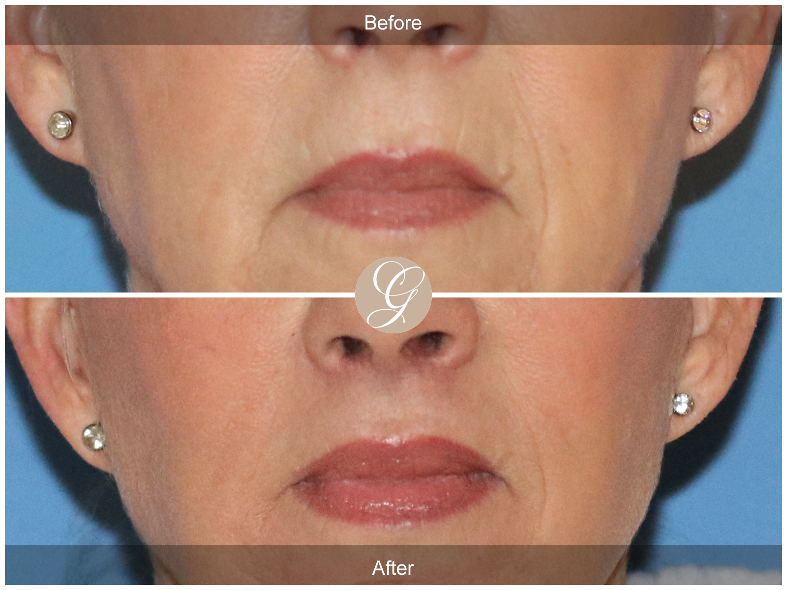 Lip Lift 0994 Image