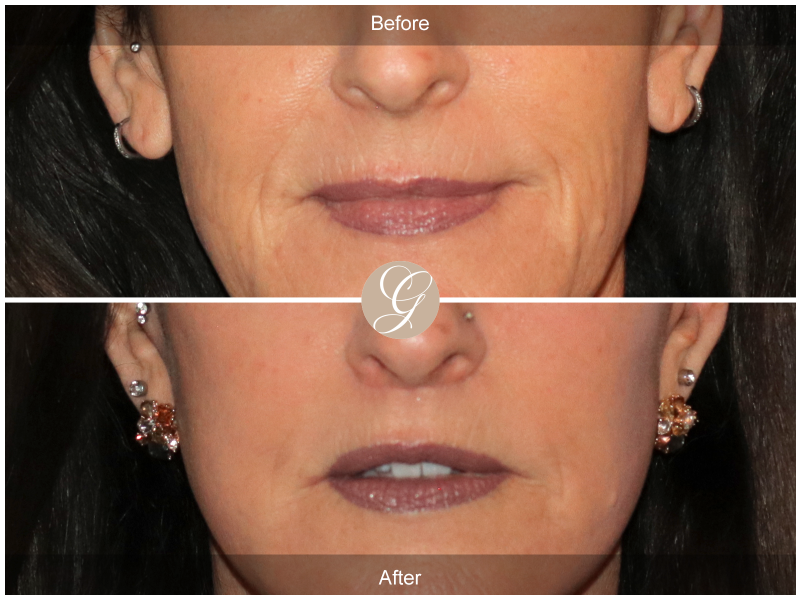 Lip Lift 0822 Image
