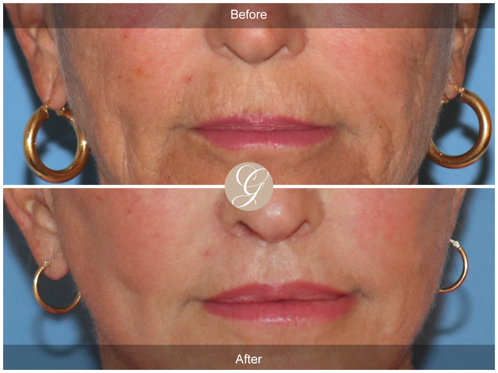 Lip Lift 5523 Image