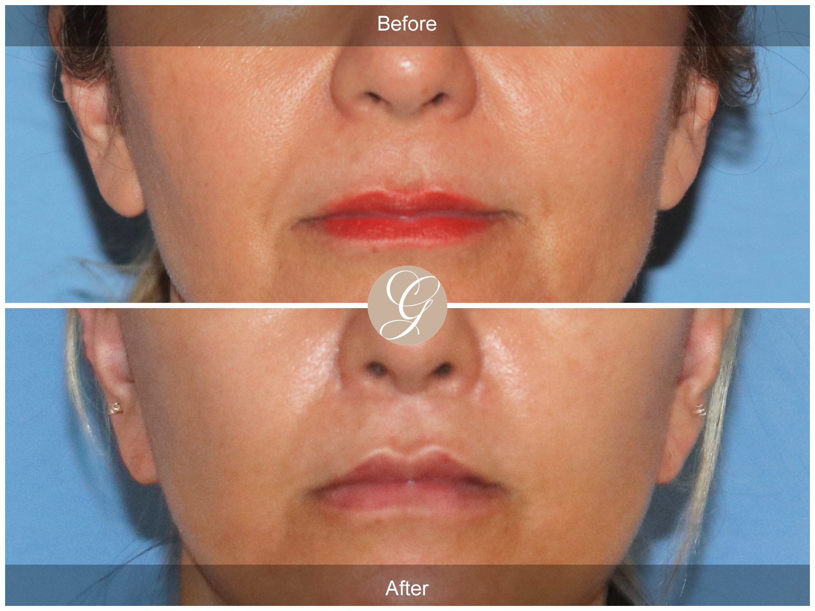 Lip Lift 5291 Image