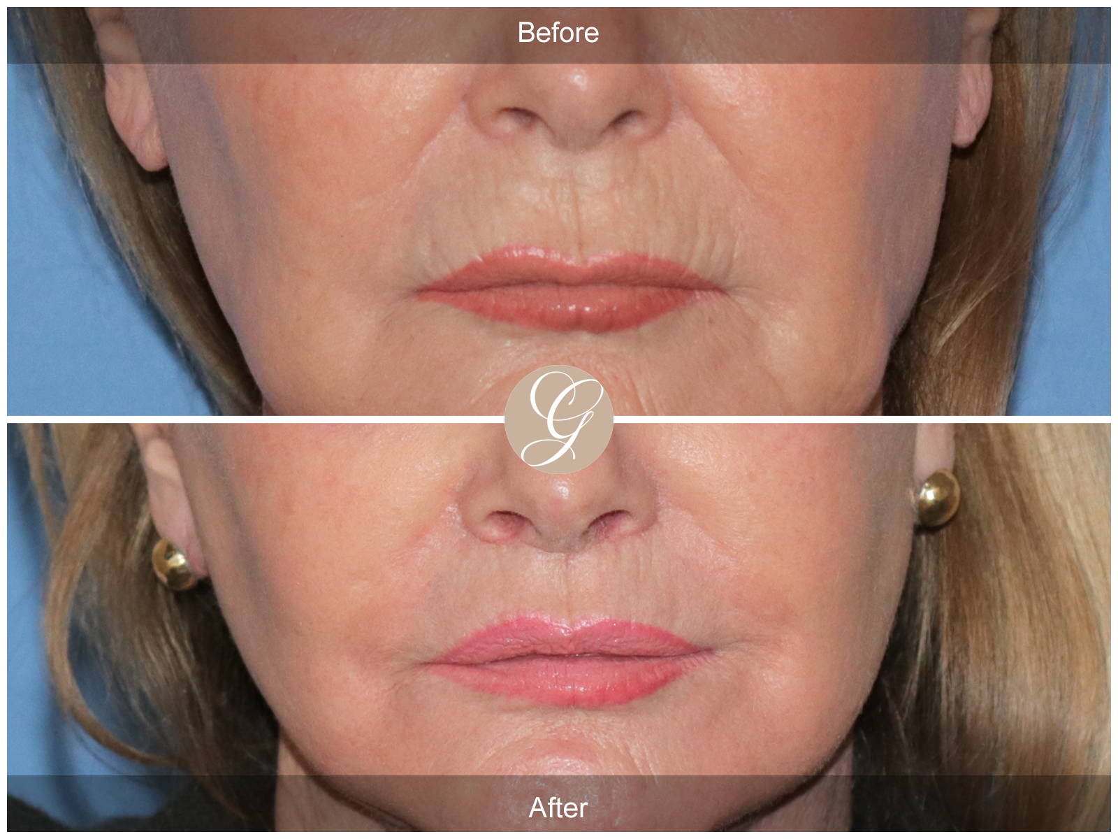 Lip Lift 0021 Image