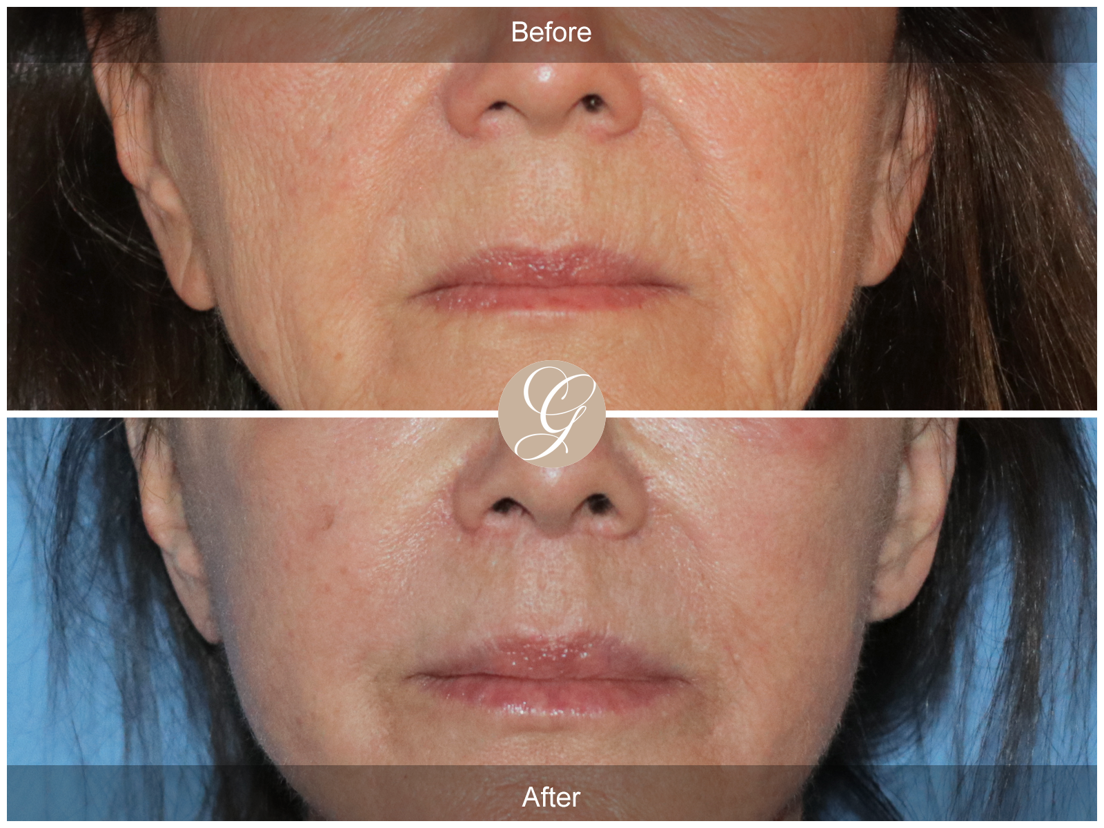 Lip Lift 0833 Image