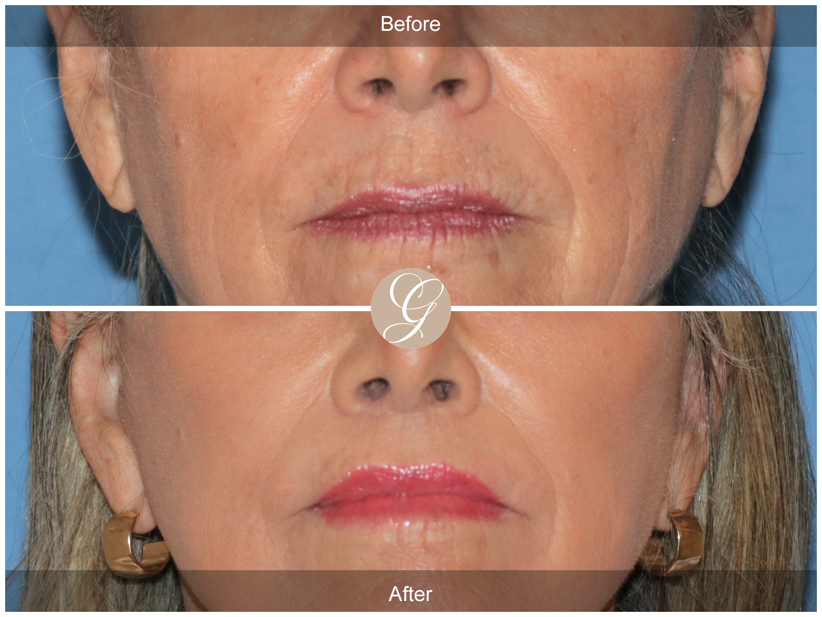 Lip Lift 0041 Image