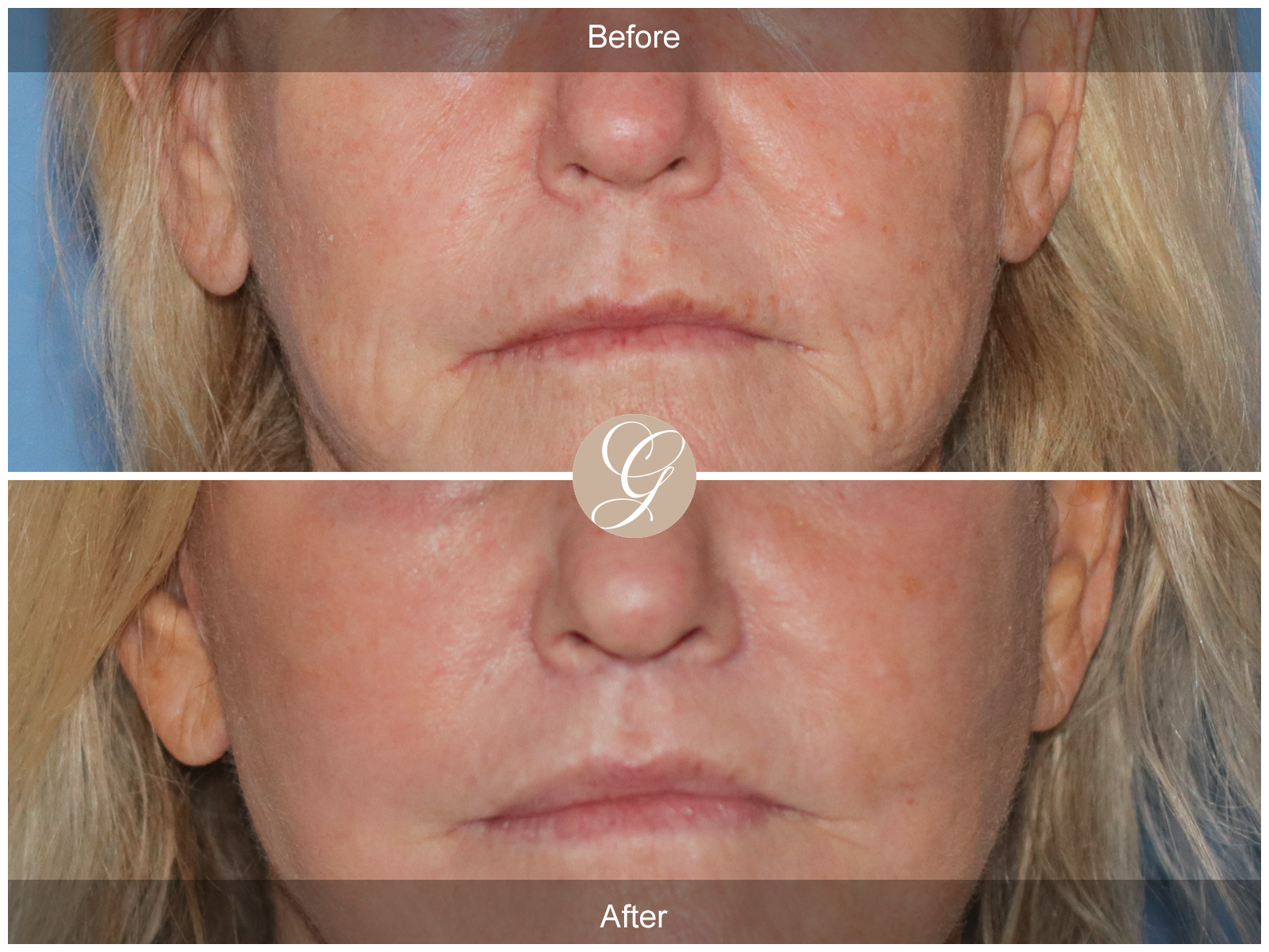 Lip Lift 5441 Image