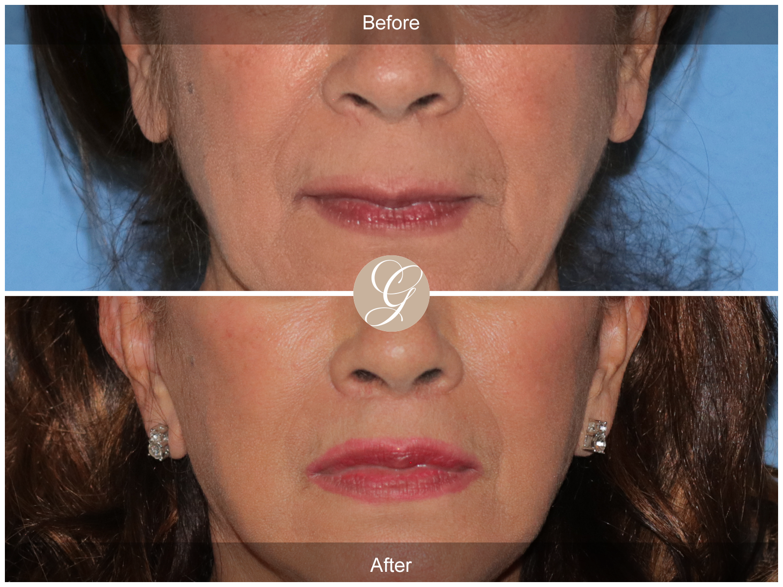 Lip Lift 9082 Image