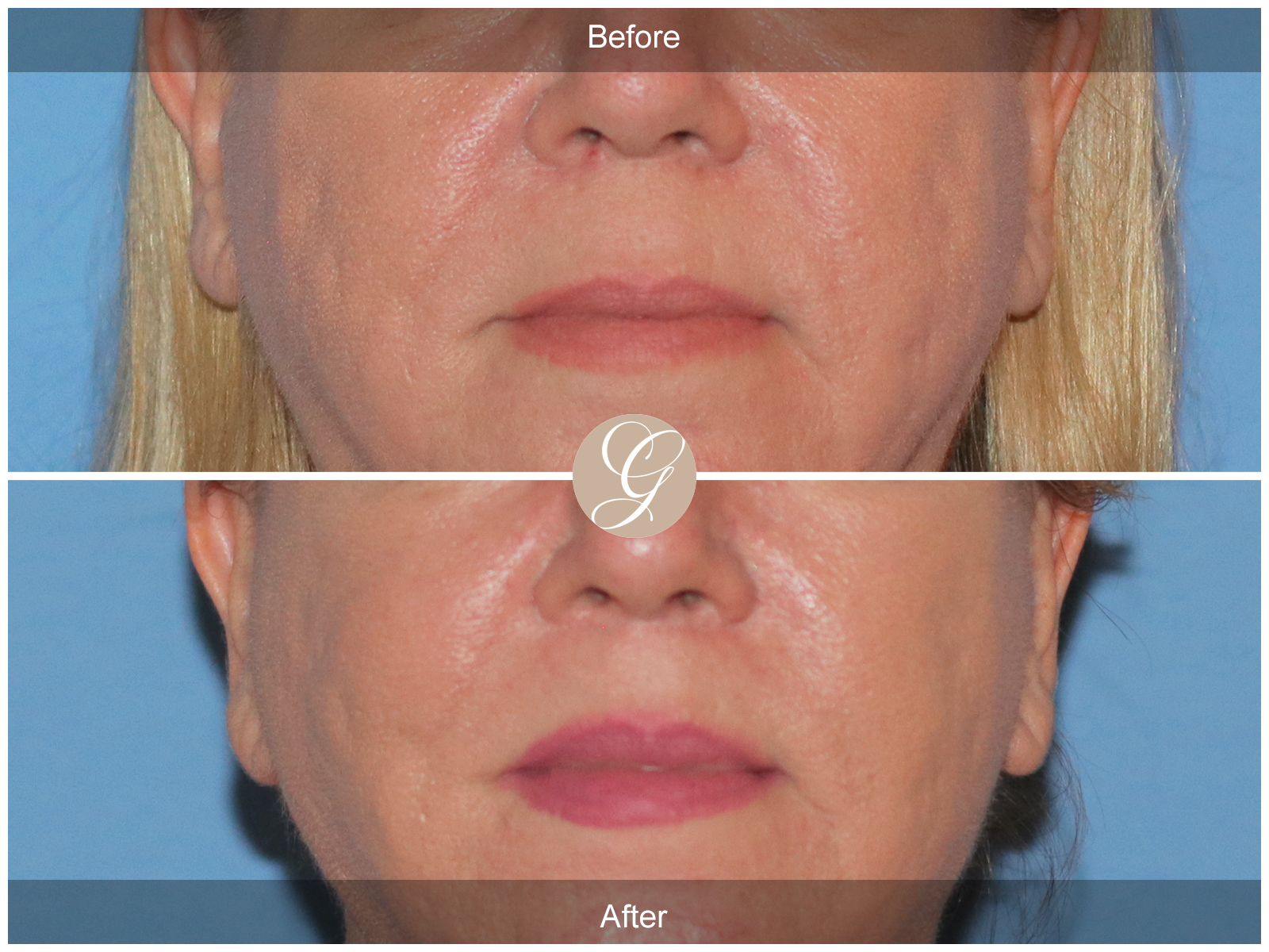 Lip Lift 9655 Image