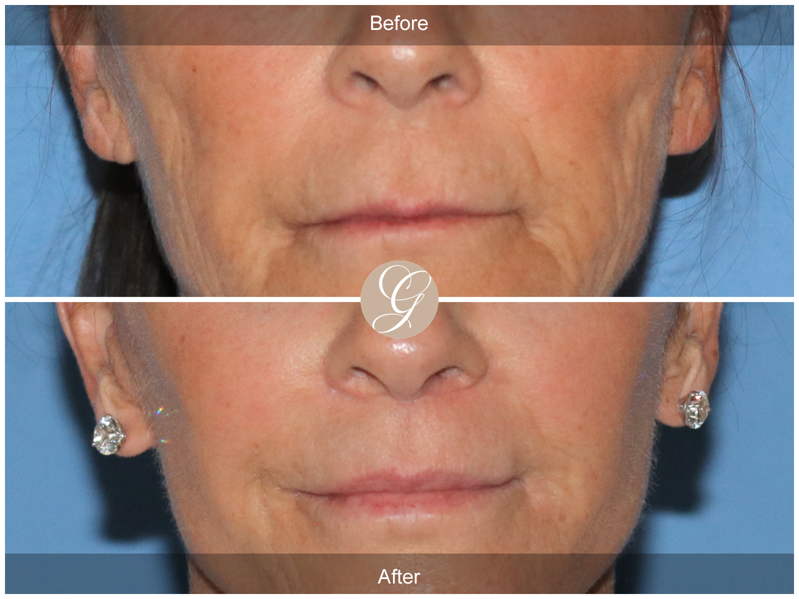 Lip Lift 7094 Image