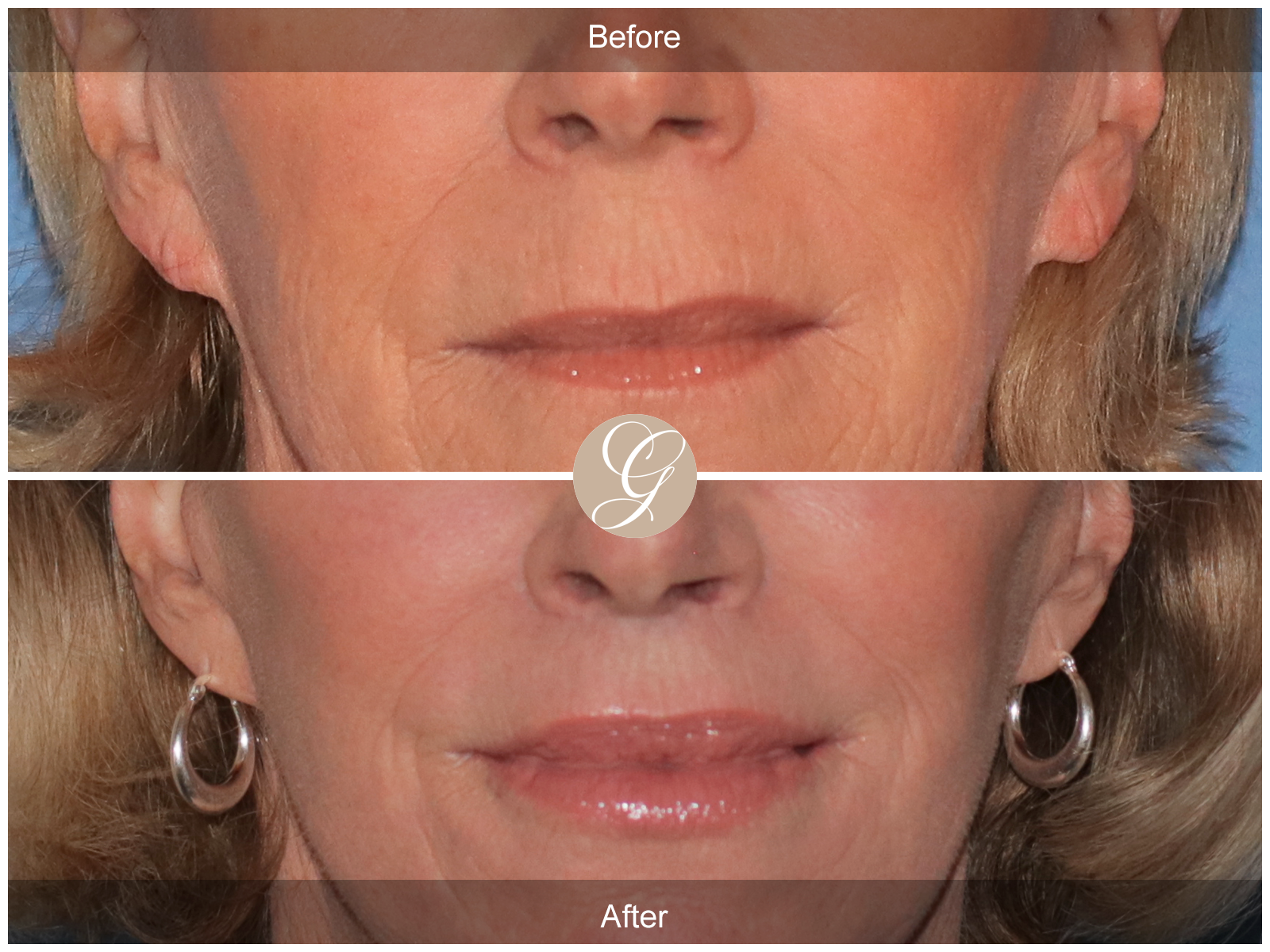 Lip Lift 2100 Image