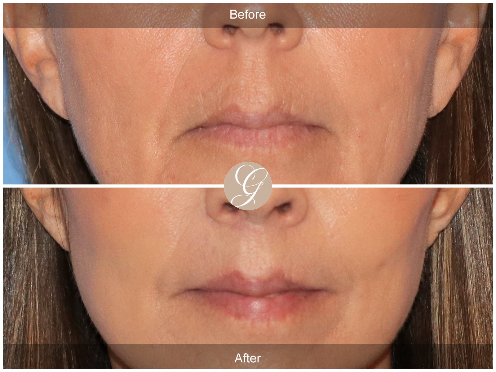 Lip Lift 4821 Image