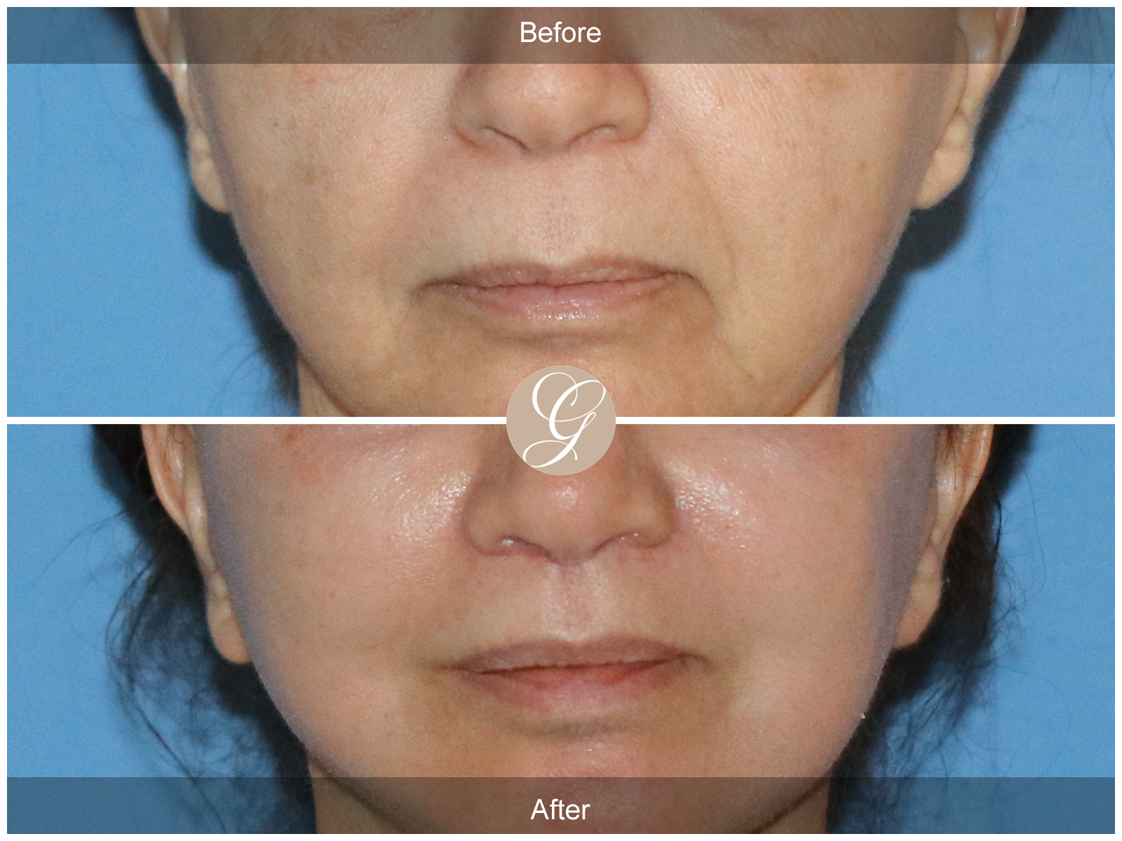 Lip Lift 0456 Image