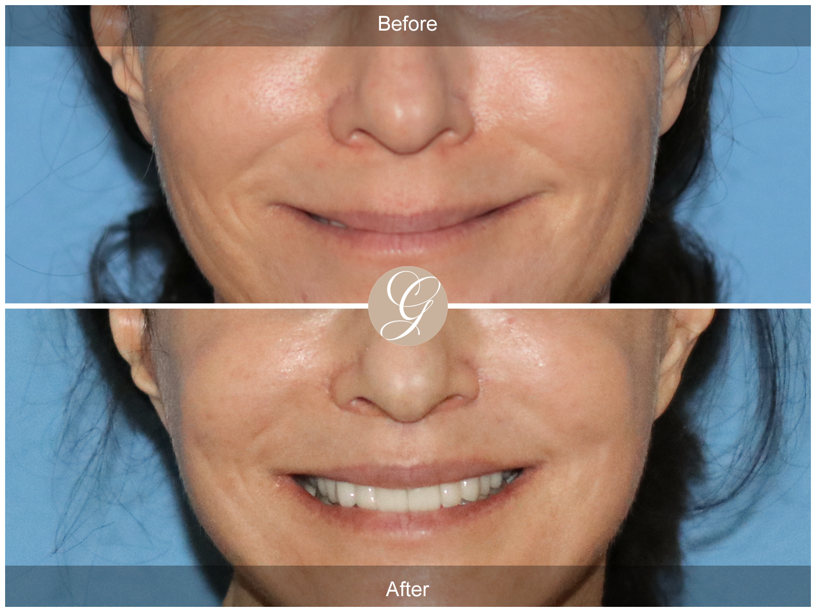 Lip Lift 8831 Image