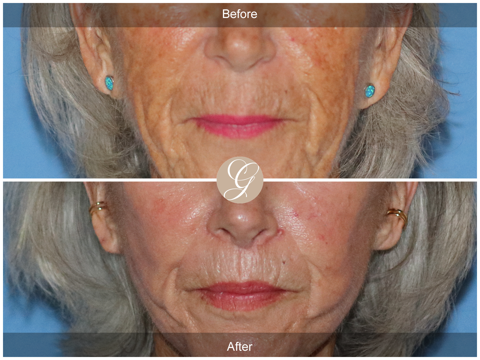 Lip Lift 0883 Image