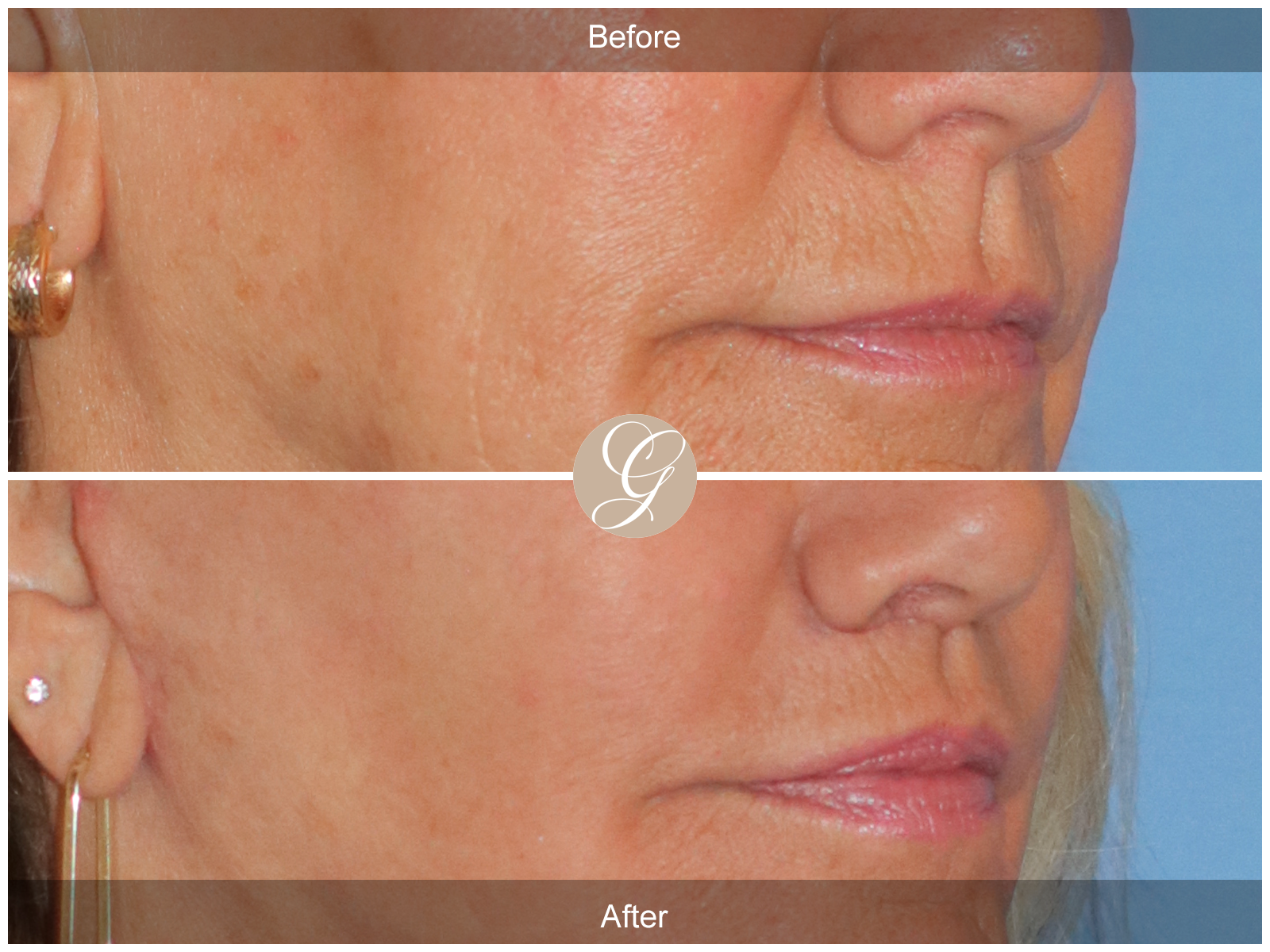 Lip Lift 2096 Image